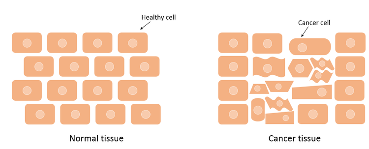 Comparison between healthy tissue and cancerous tissue