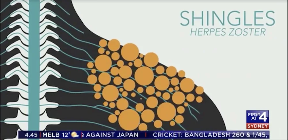 Shingles on 7 News.jpg