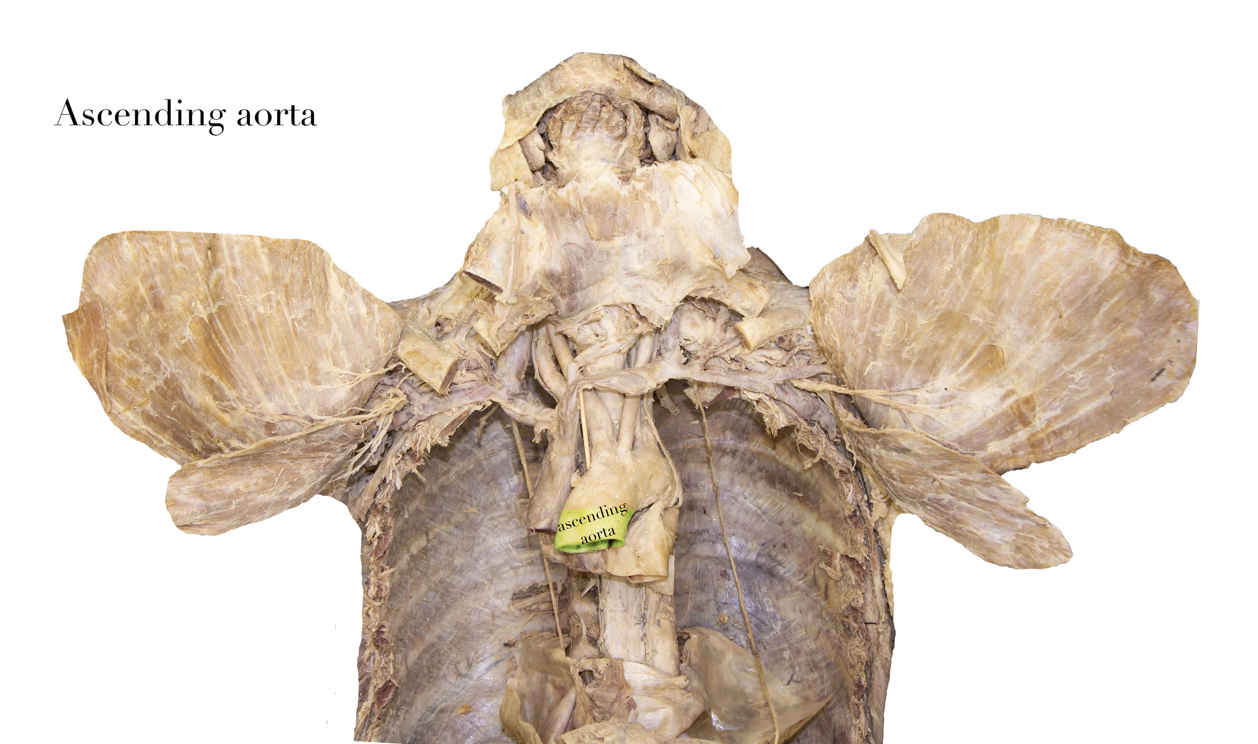 AscendingAorta_editedimage_labelled2.jpg