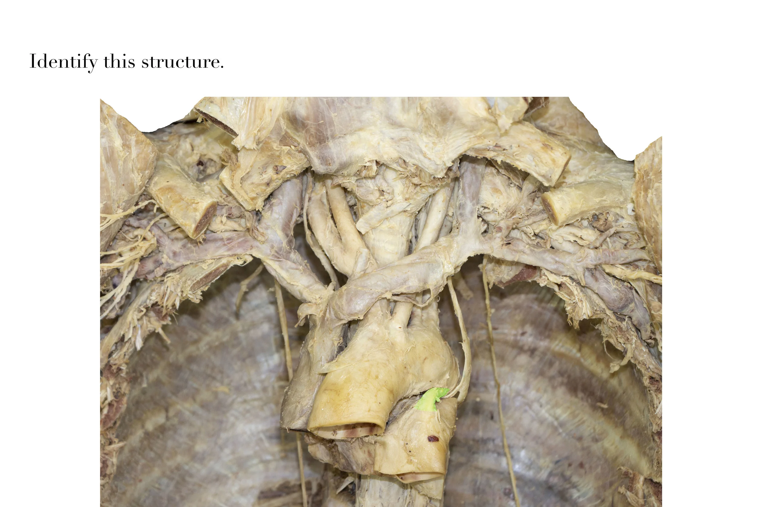 LigamentumArteriosum_editedimage_identify.jpg