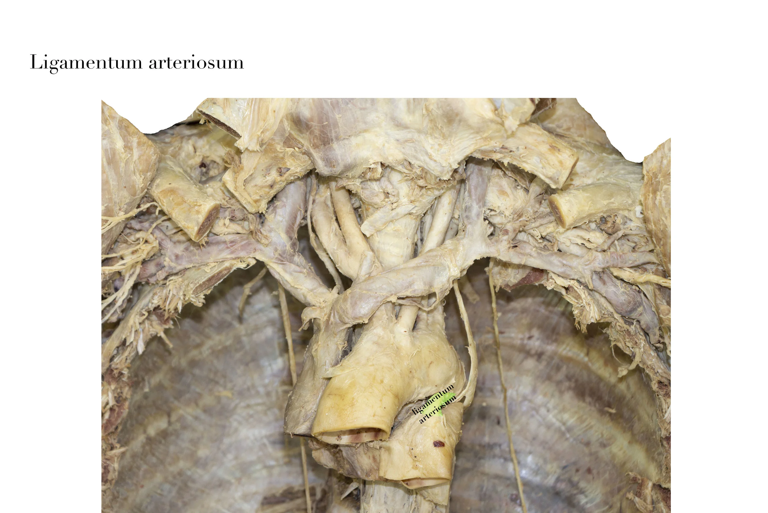 LigamentumArteriosum_editedimage_labelled2.jpg