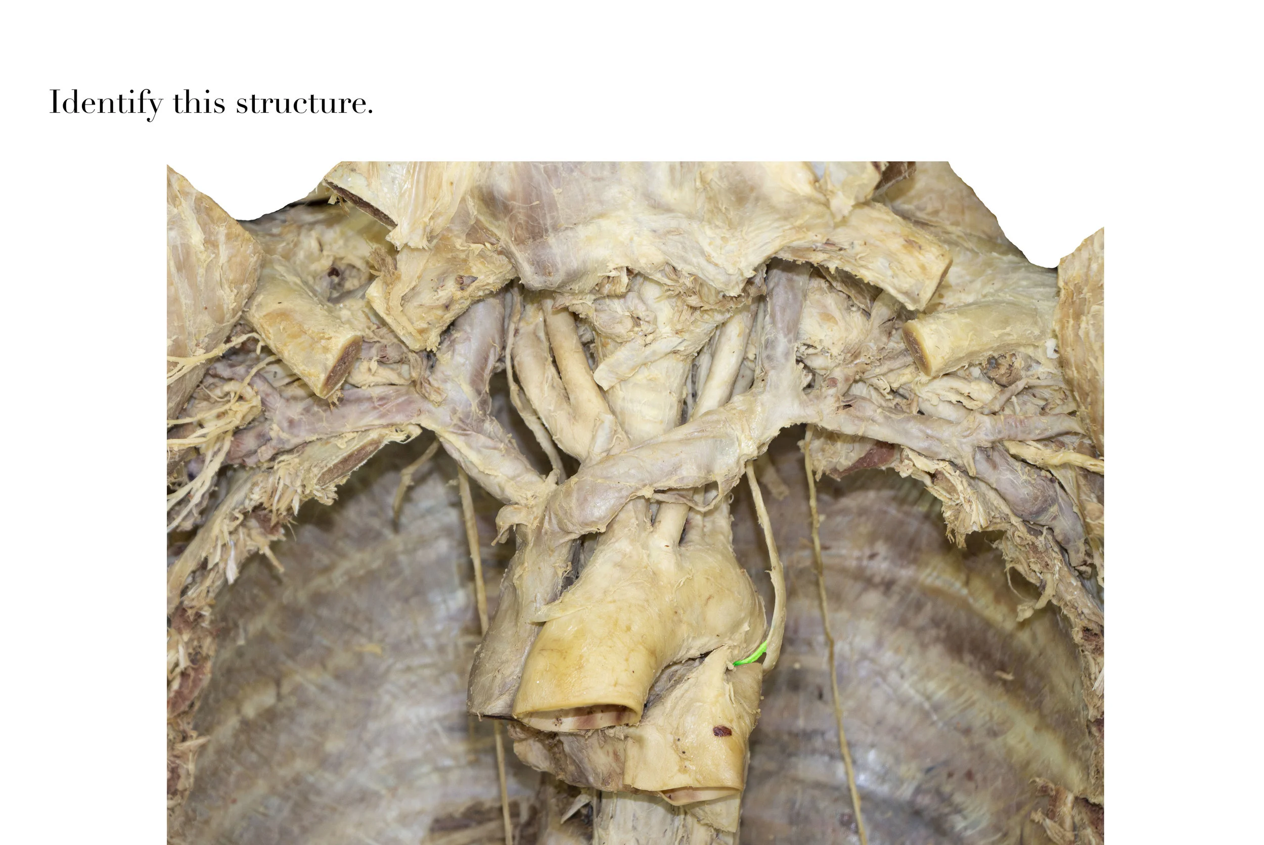 RecurrentLaryngealNerveL_editedimage_identify.jpg