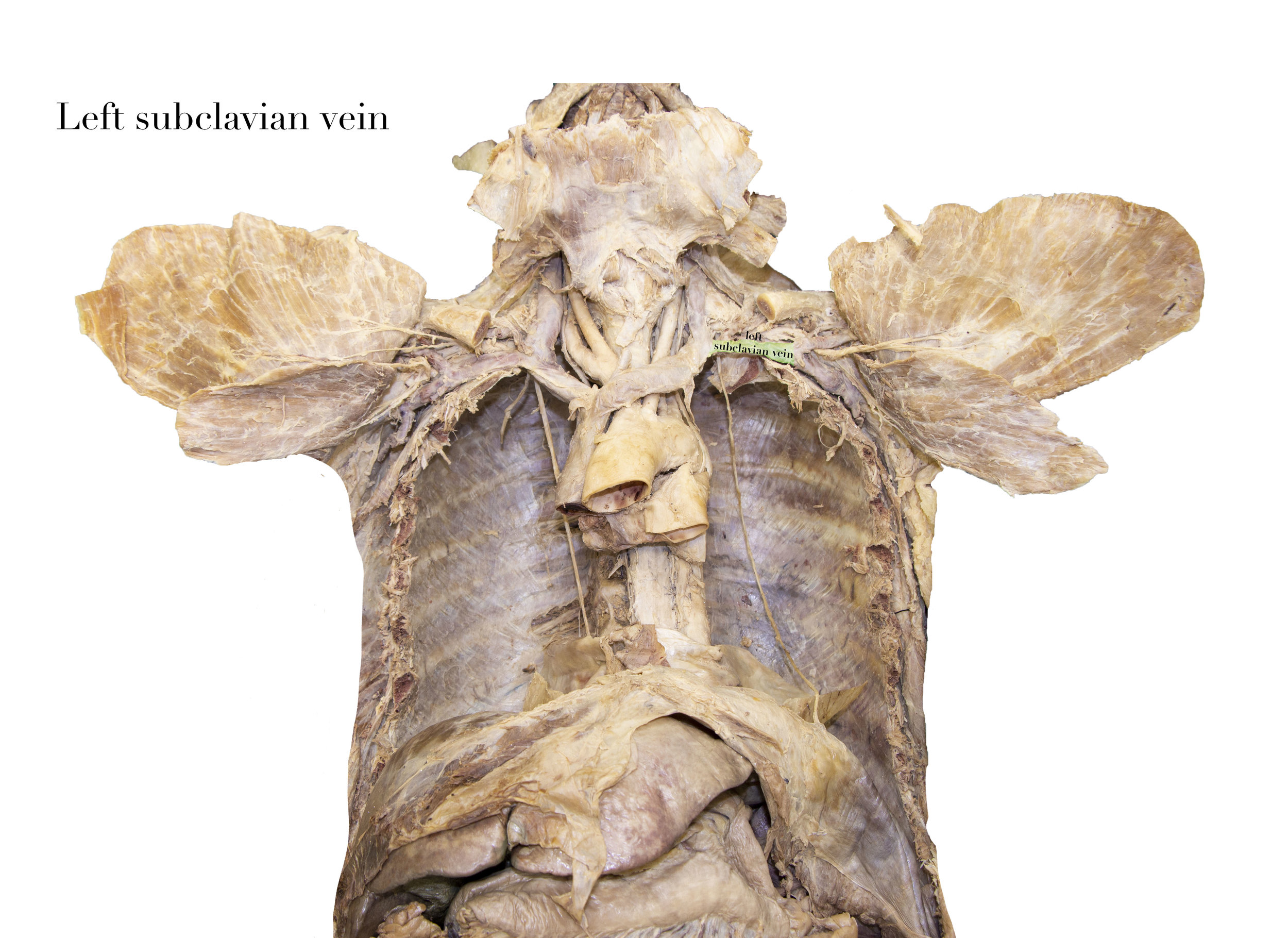 SubclavianVeinL_editedimage_labelled2.jpg