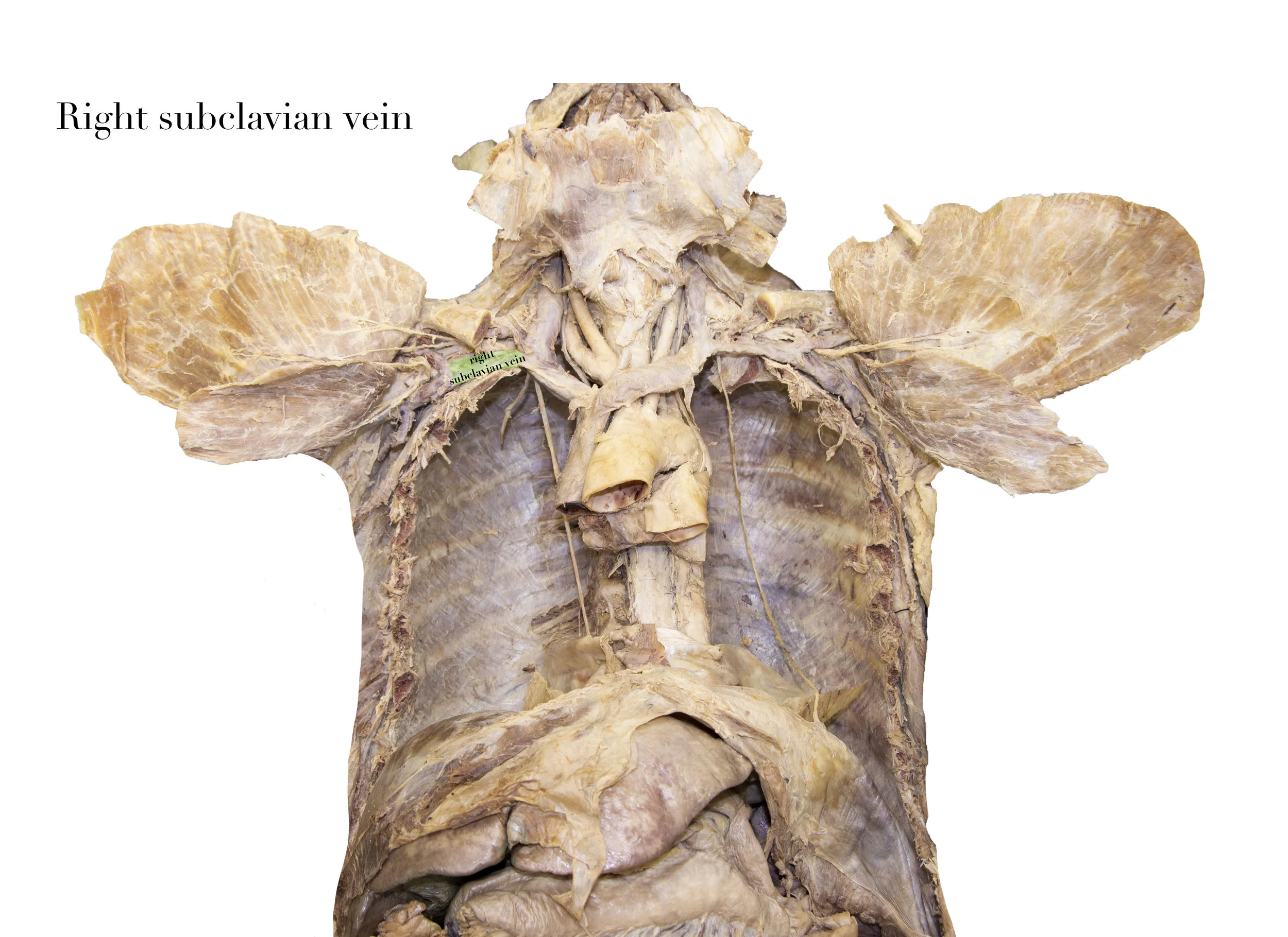 SubclavianVeinR_editedimage_labelled2.jpg