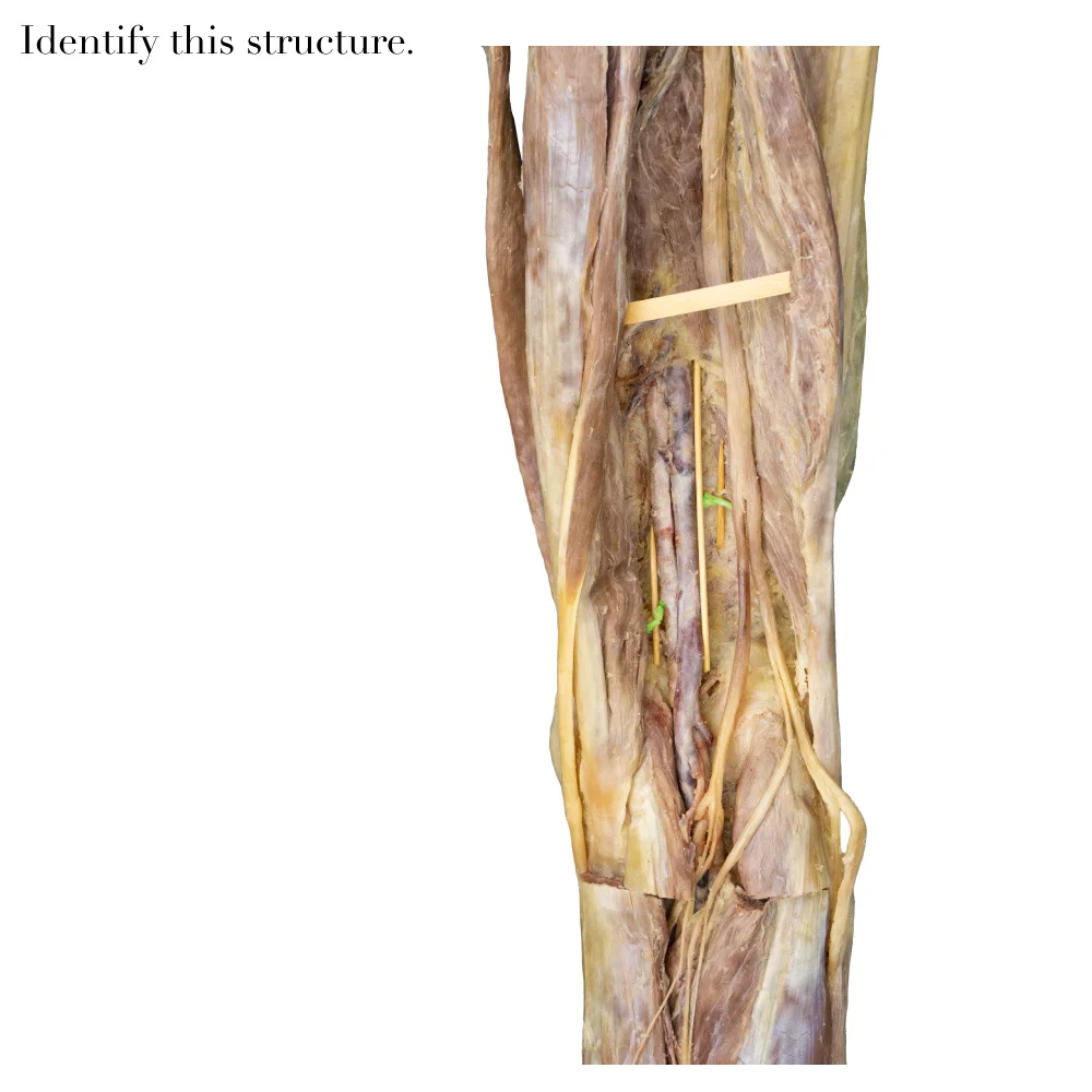 GenicularArteries_editedimage_identify.jpg