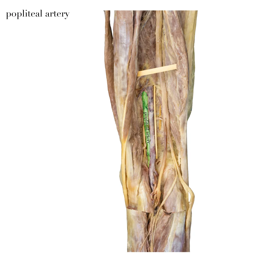 PoplitealArtery_editedimage_labelled.jpg