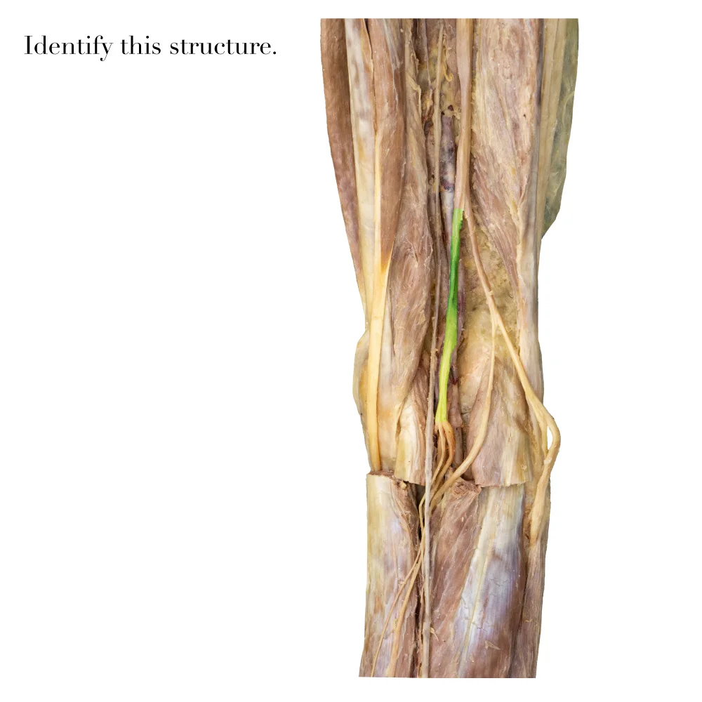 TibialNerve_editedimage_identify.jpg