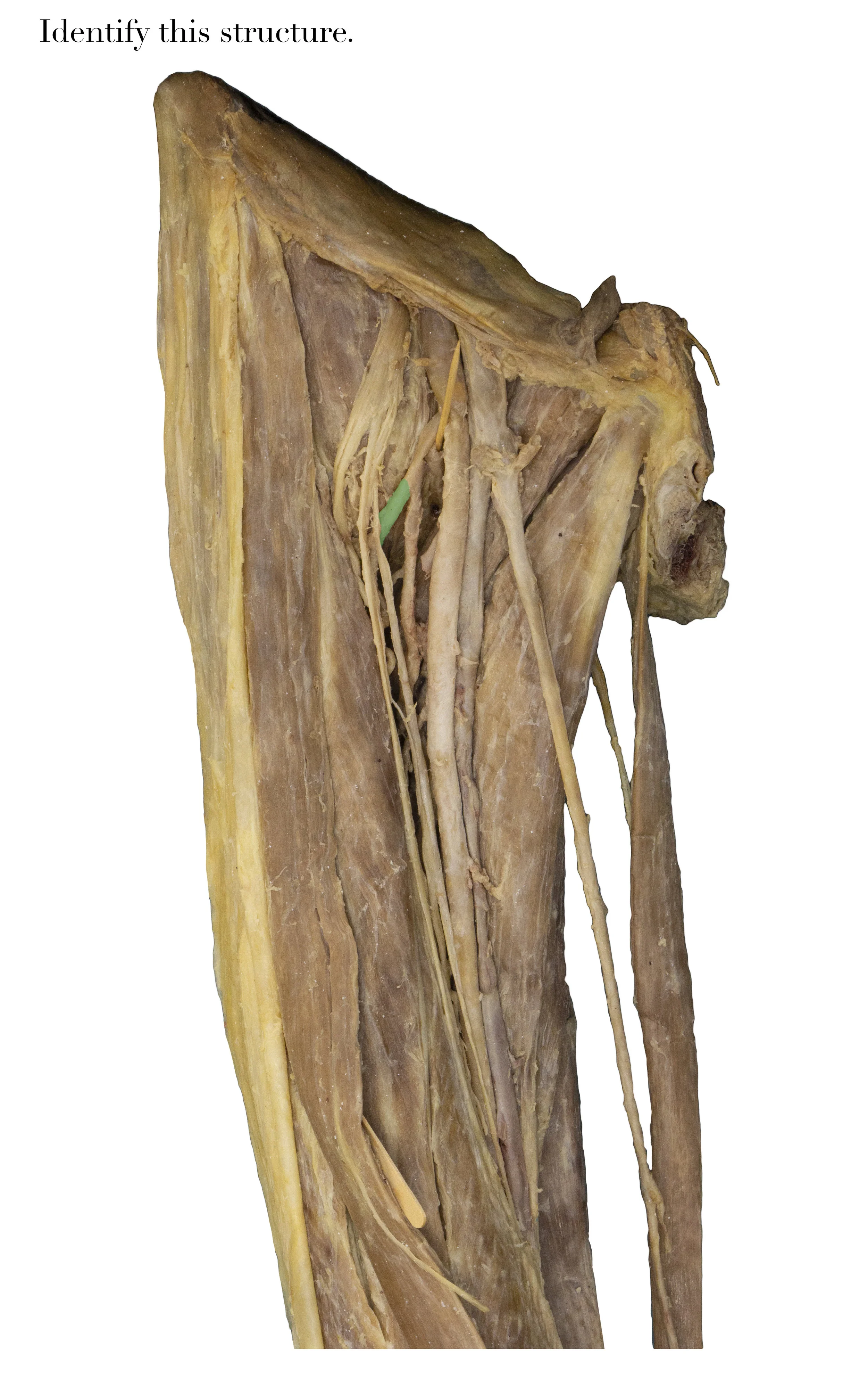 IMG_1392_lateral_femoral_circumflex_artery_identify.jpg