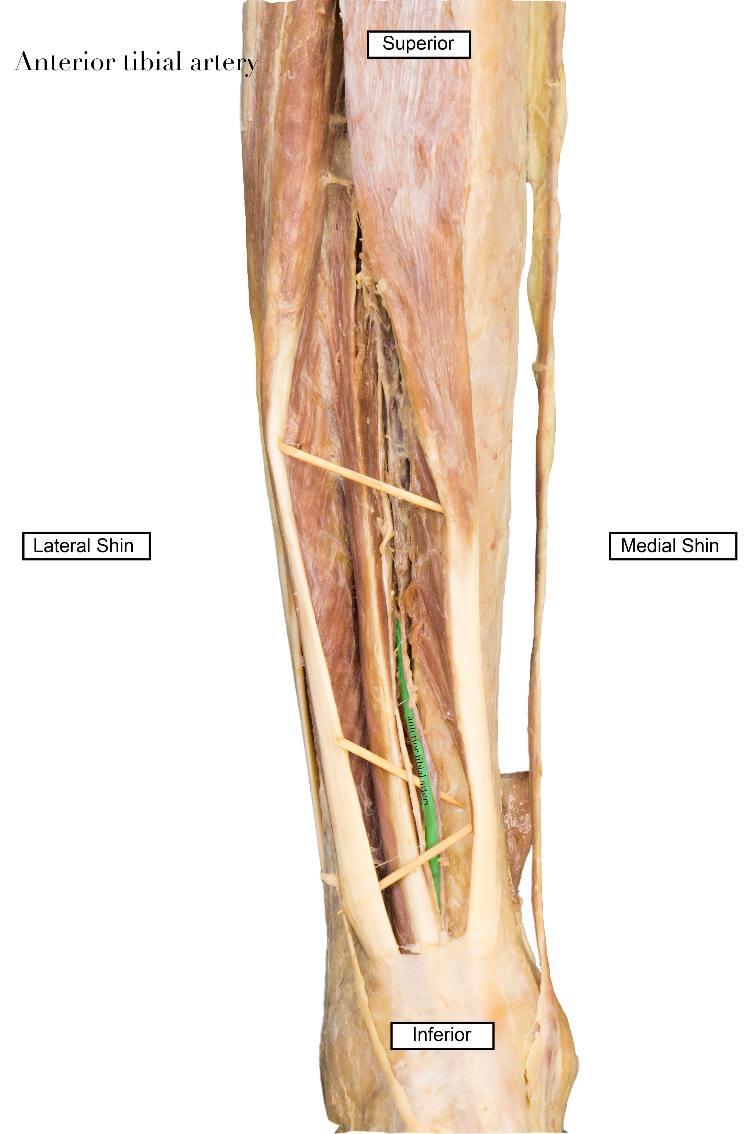 AnteriorTibialArtery_edited_labelled.jpg