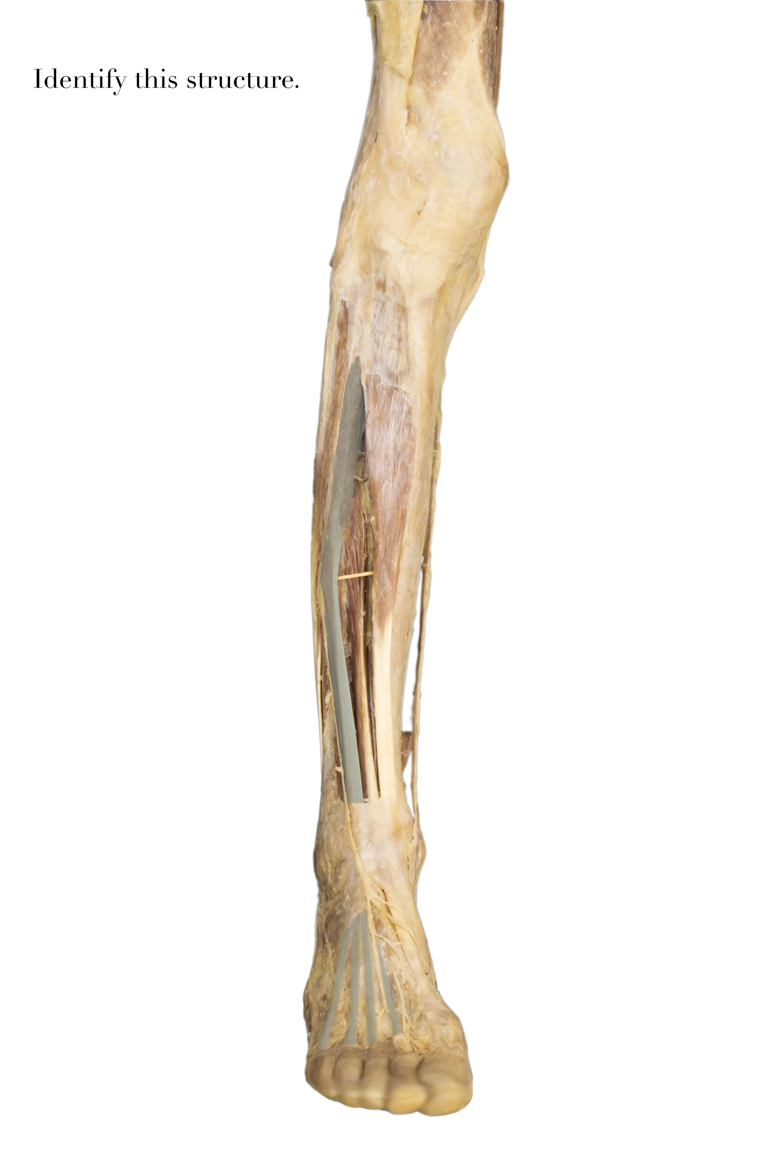 ExtensorDigitorumLongus_edited_identify.jpg