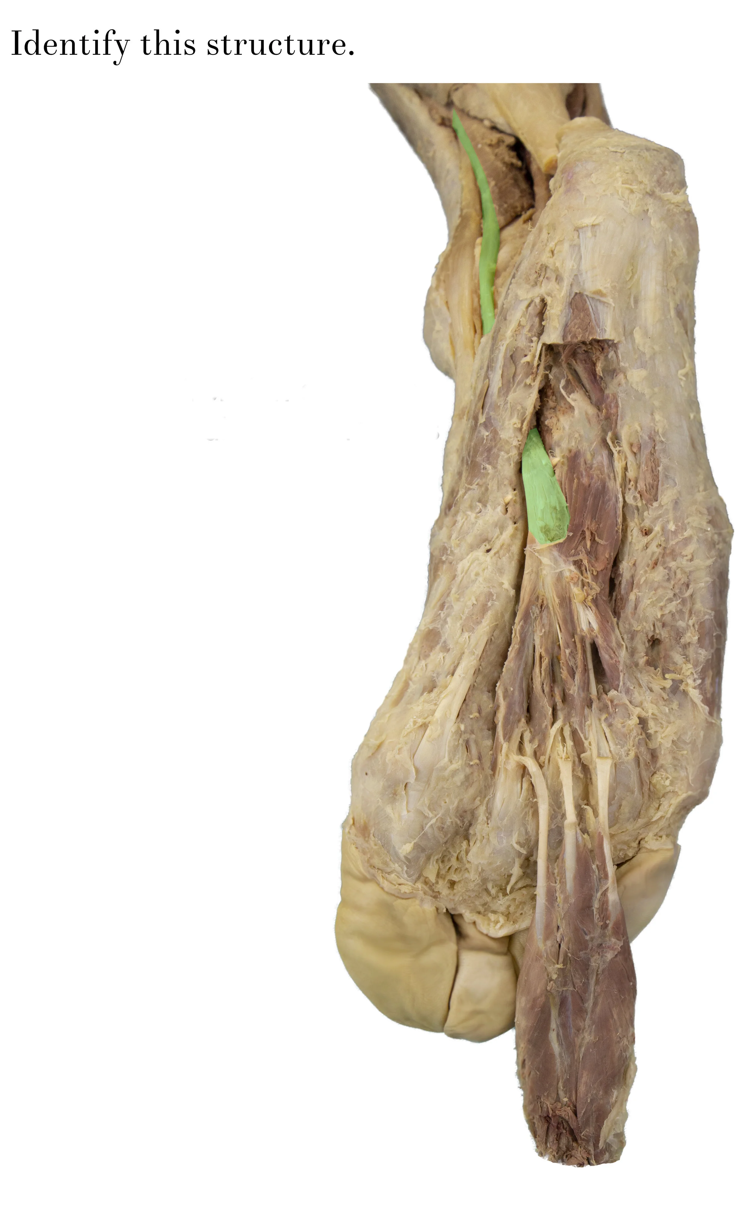 SoleTendonOfFlexorDigitorumLongus_edited_identify.jpg