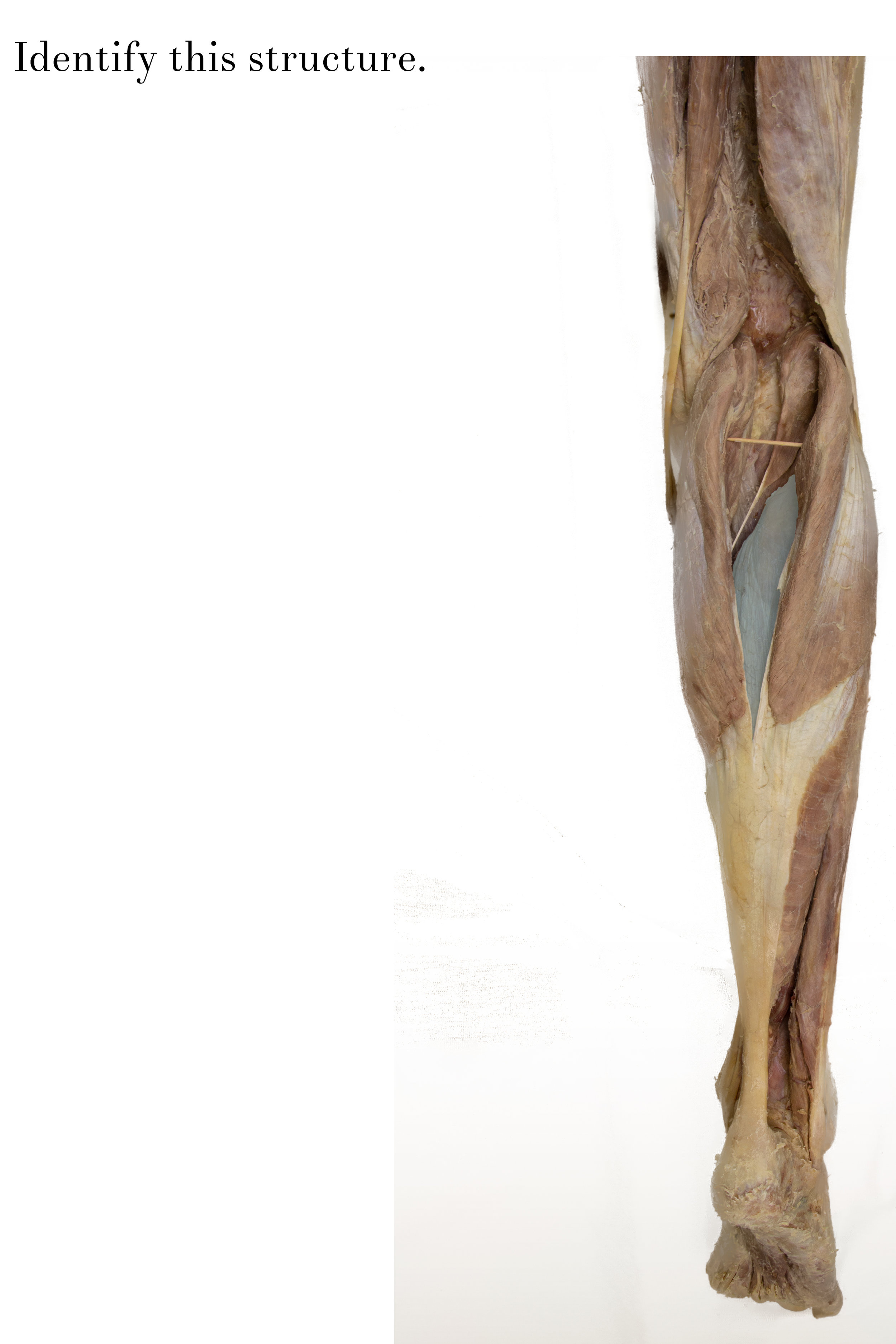 Soleus_edited_identify.jpg