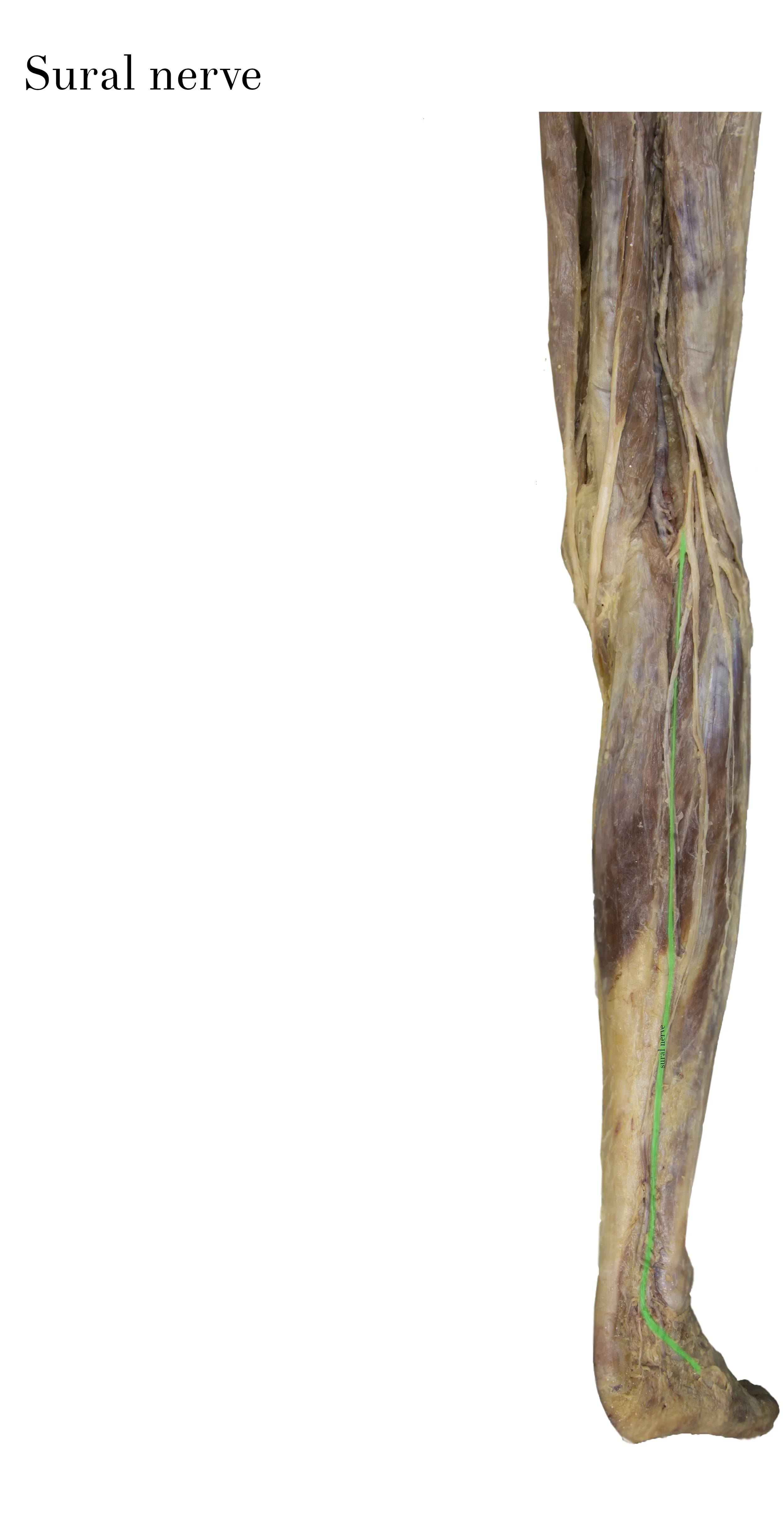 SuralNerve_edited_labelled.jpg