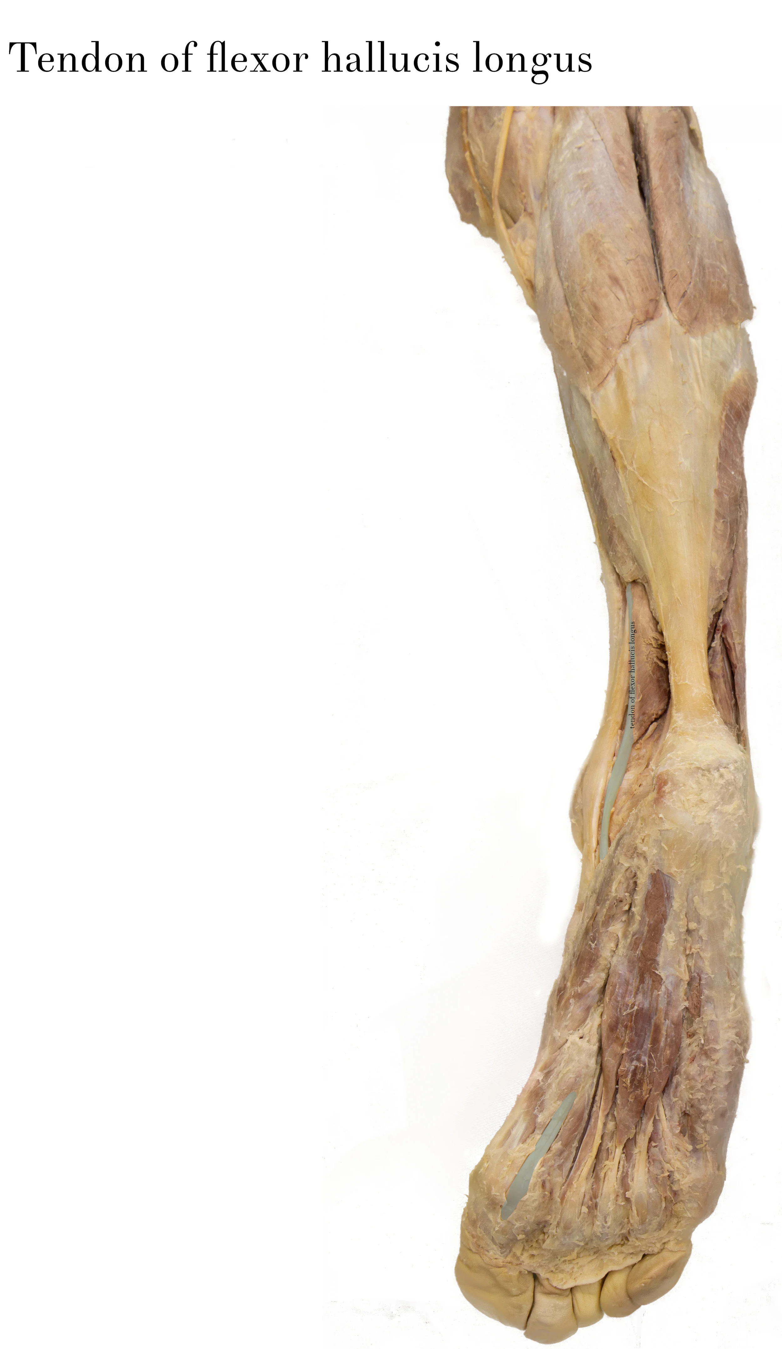 Tendon of flexor hallucis longus_edited_labelled.jpg