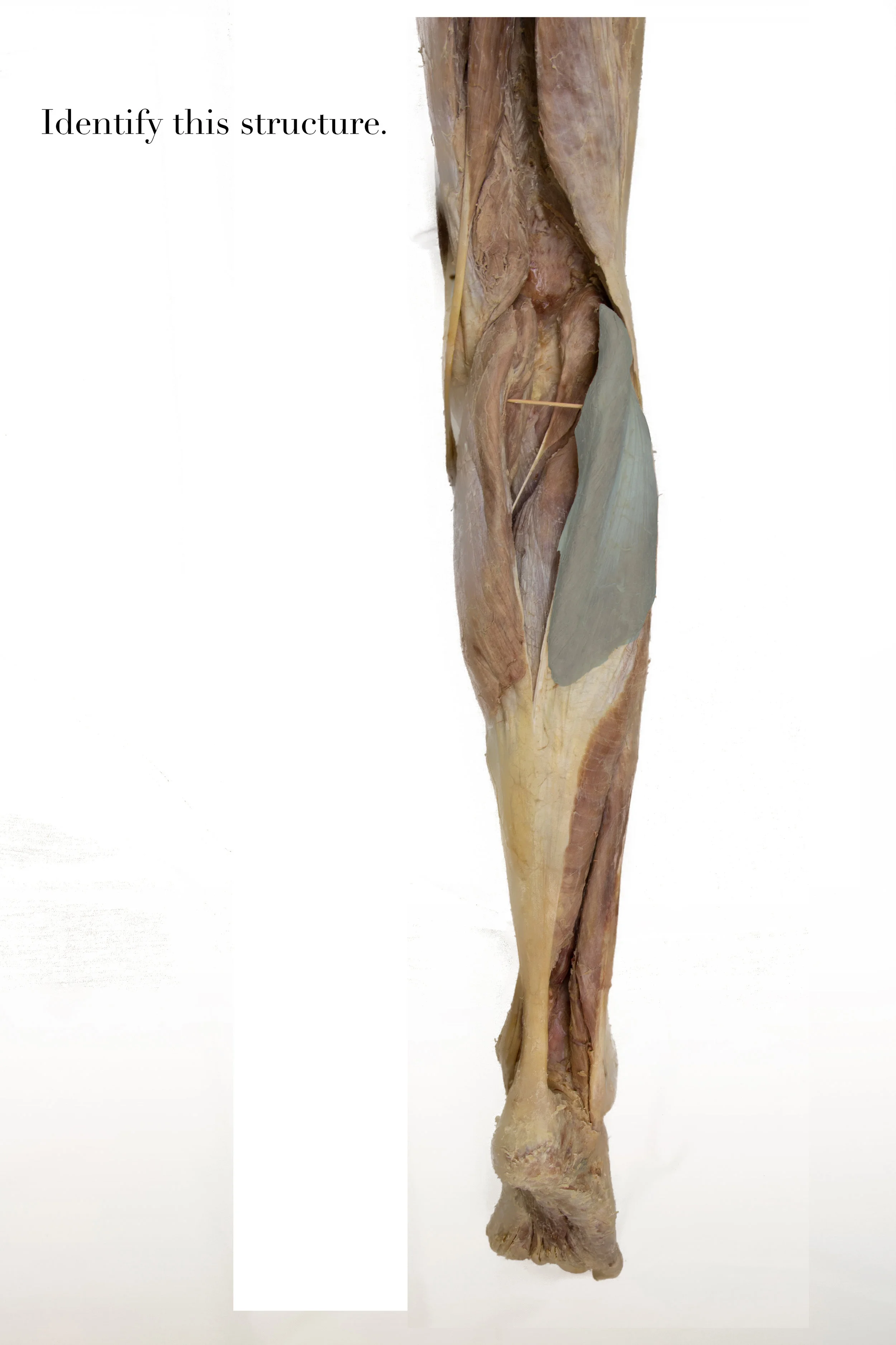 LateralHeadofGastrocnemius_edited_identify.jpg
