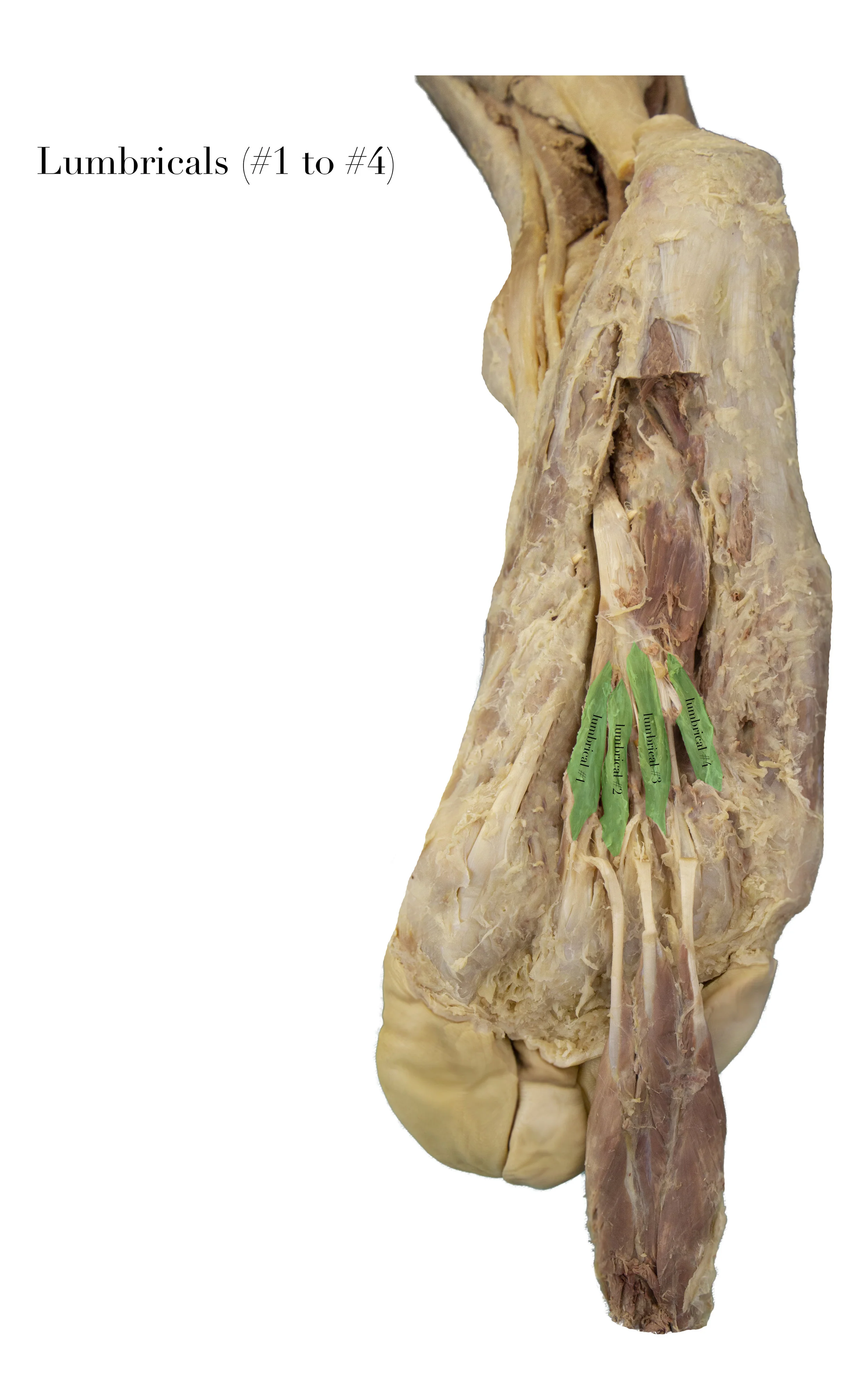 Lumbricals_edited_labelled.jpg