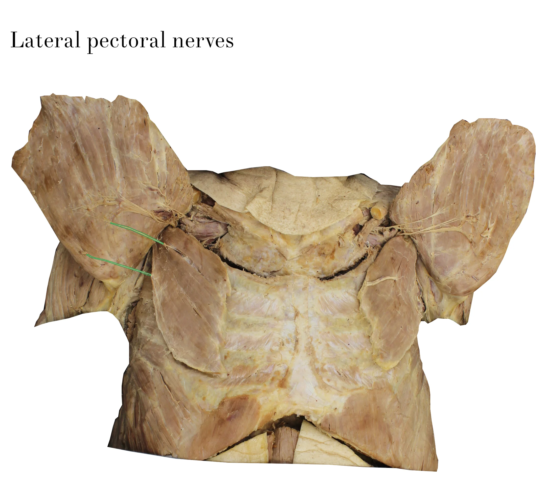 Copy of IMG_9777_lateral_pectoral_nerves_labelled.jpg