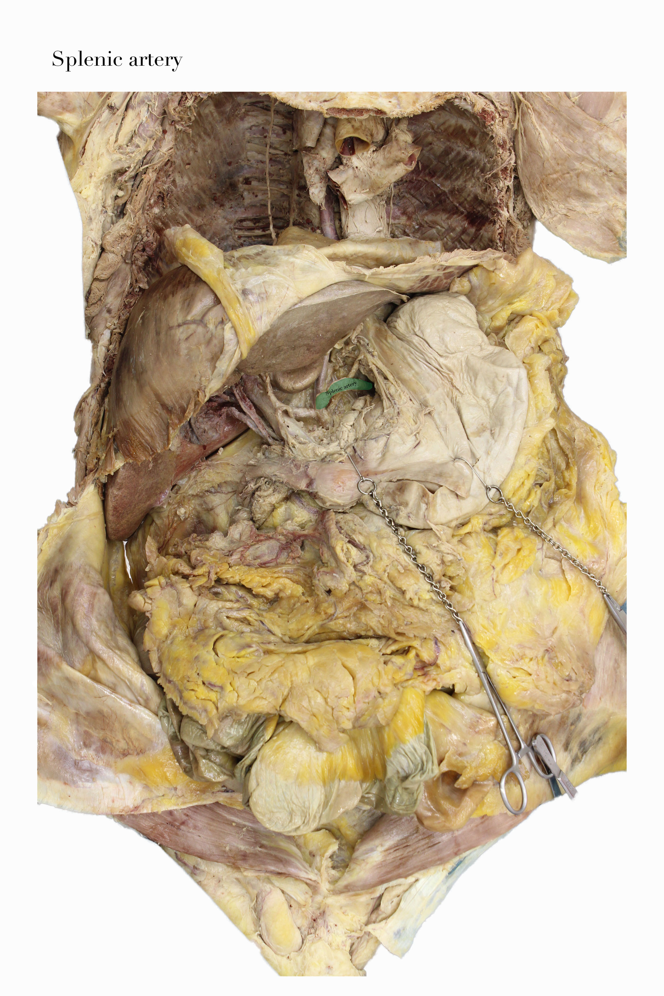 SplenicArtery_edited_labelled.jpg