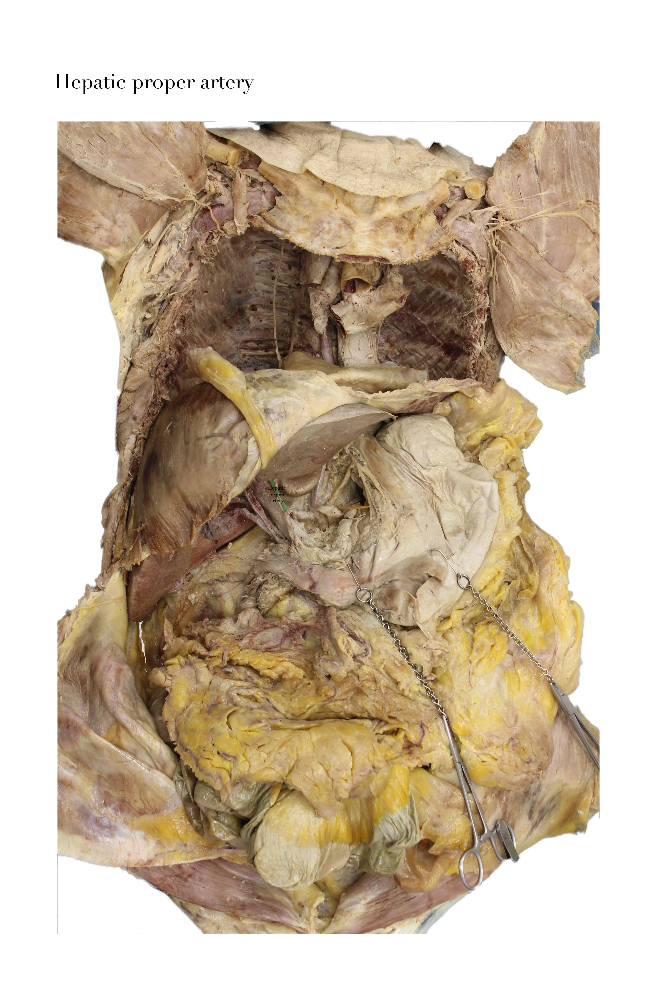 HepaticProperArtery_edited_labelled.jpg