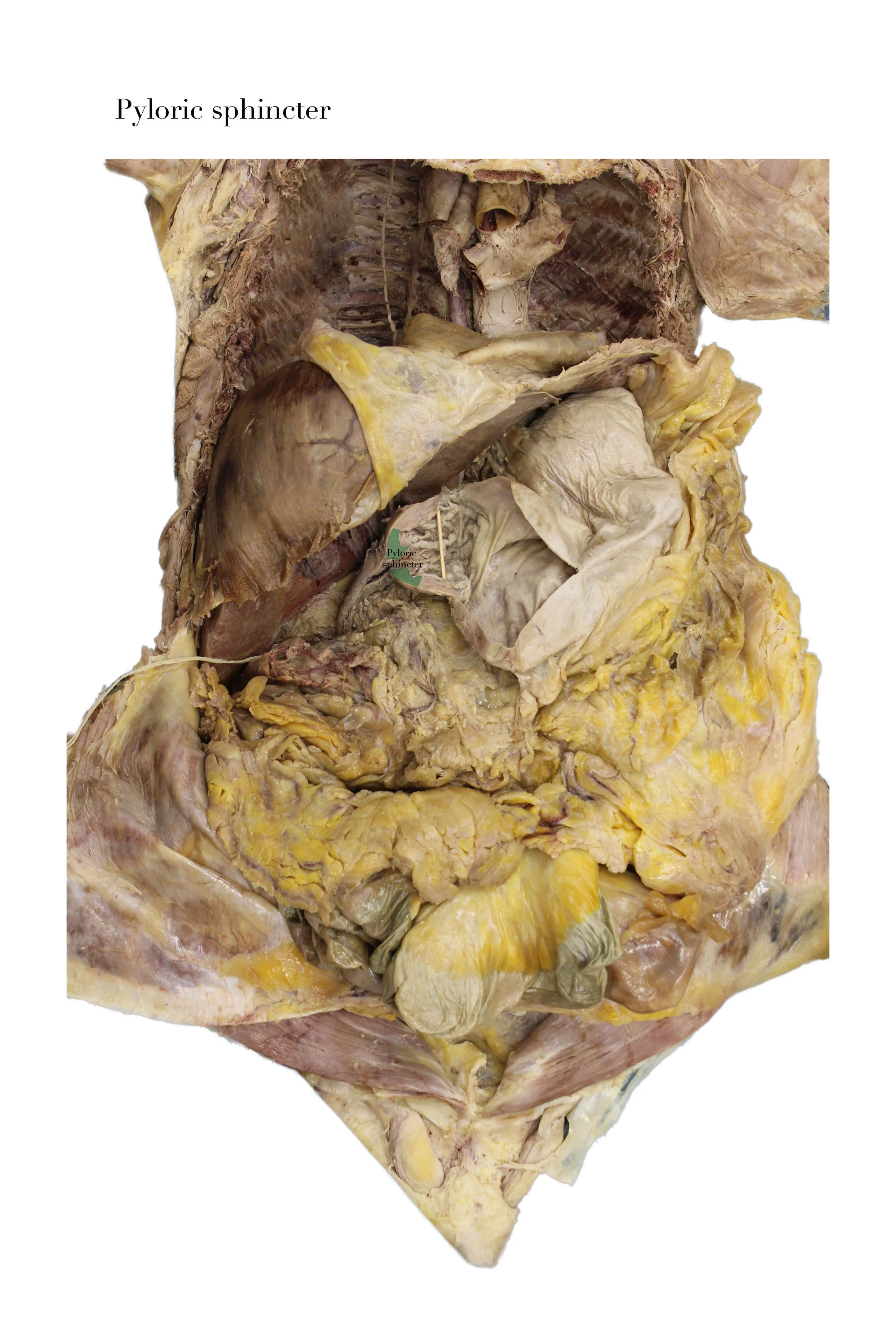 PyloricSphincter_edited_labelled.jpg