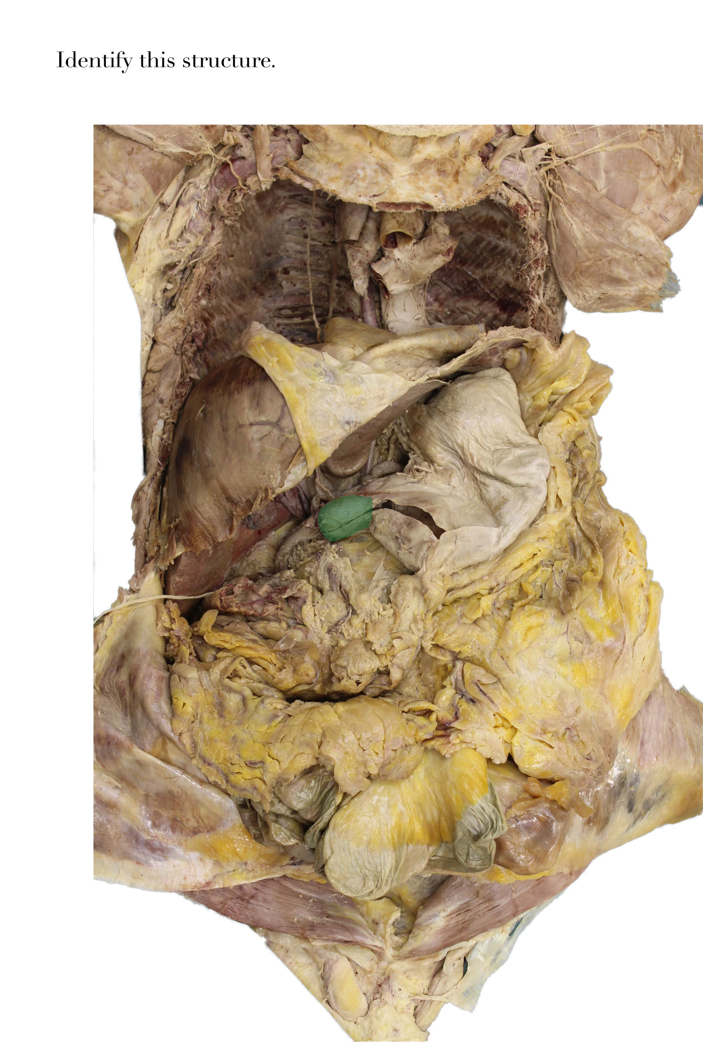 PylorusofStomach_edited_identify.jpg