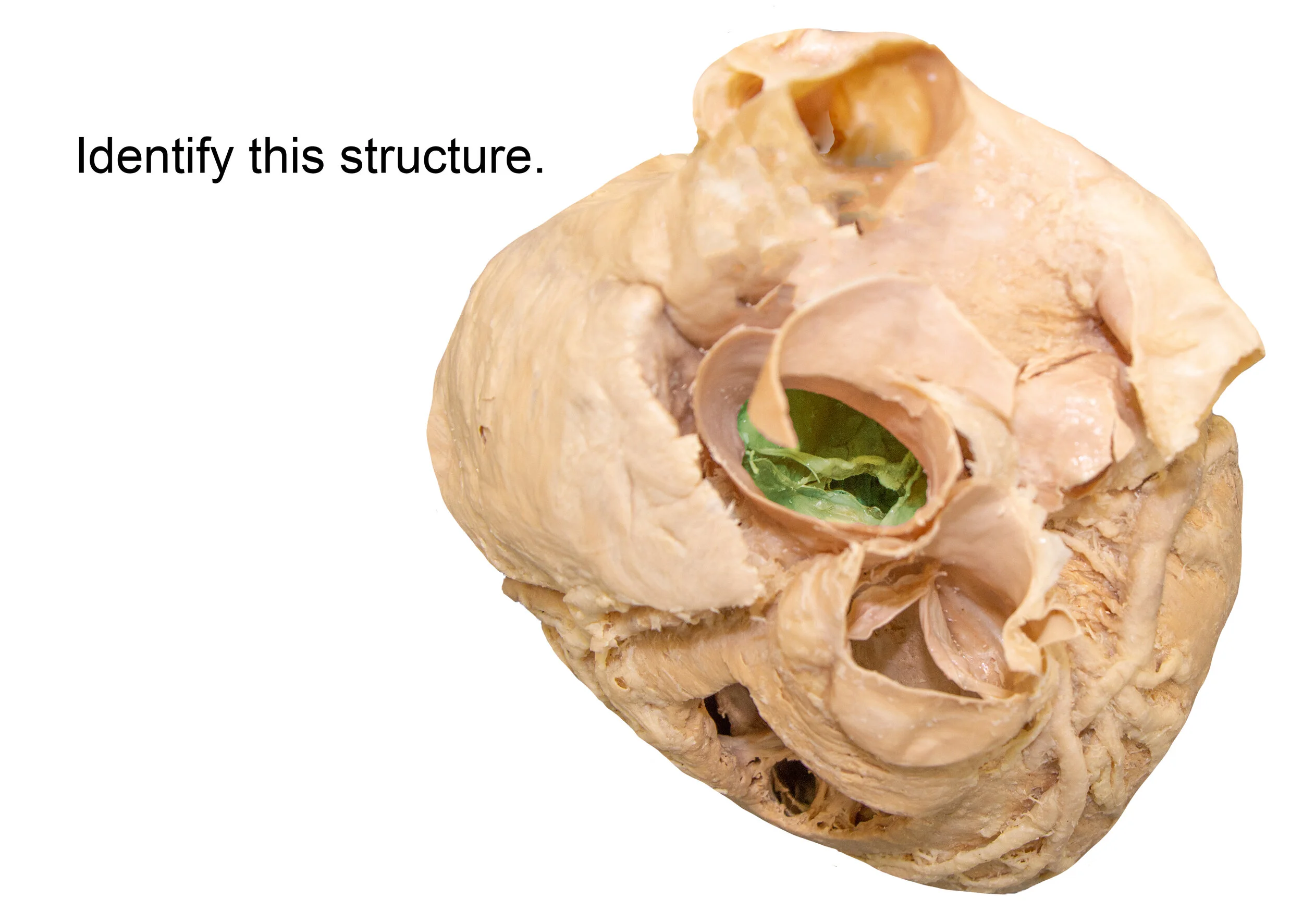 AorticValve_editedimage_identify.jpg
