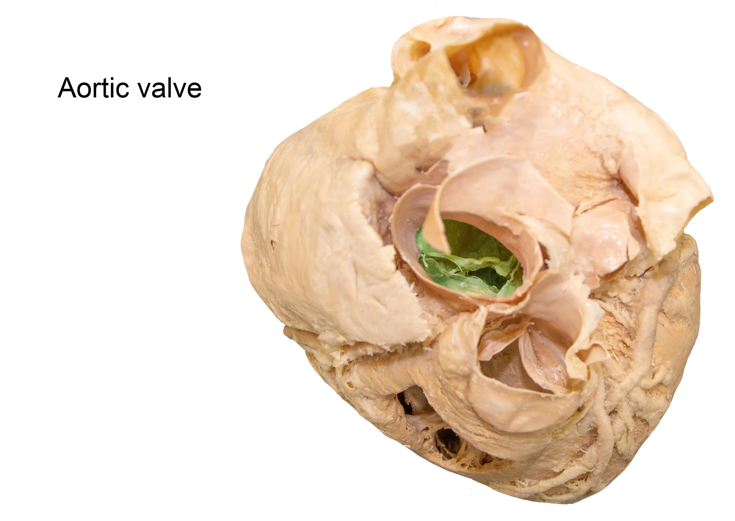 AorticValve_editedimage_labelled.jpg