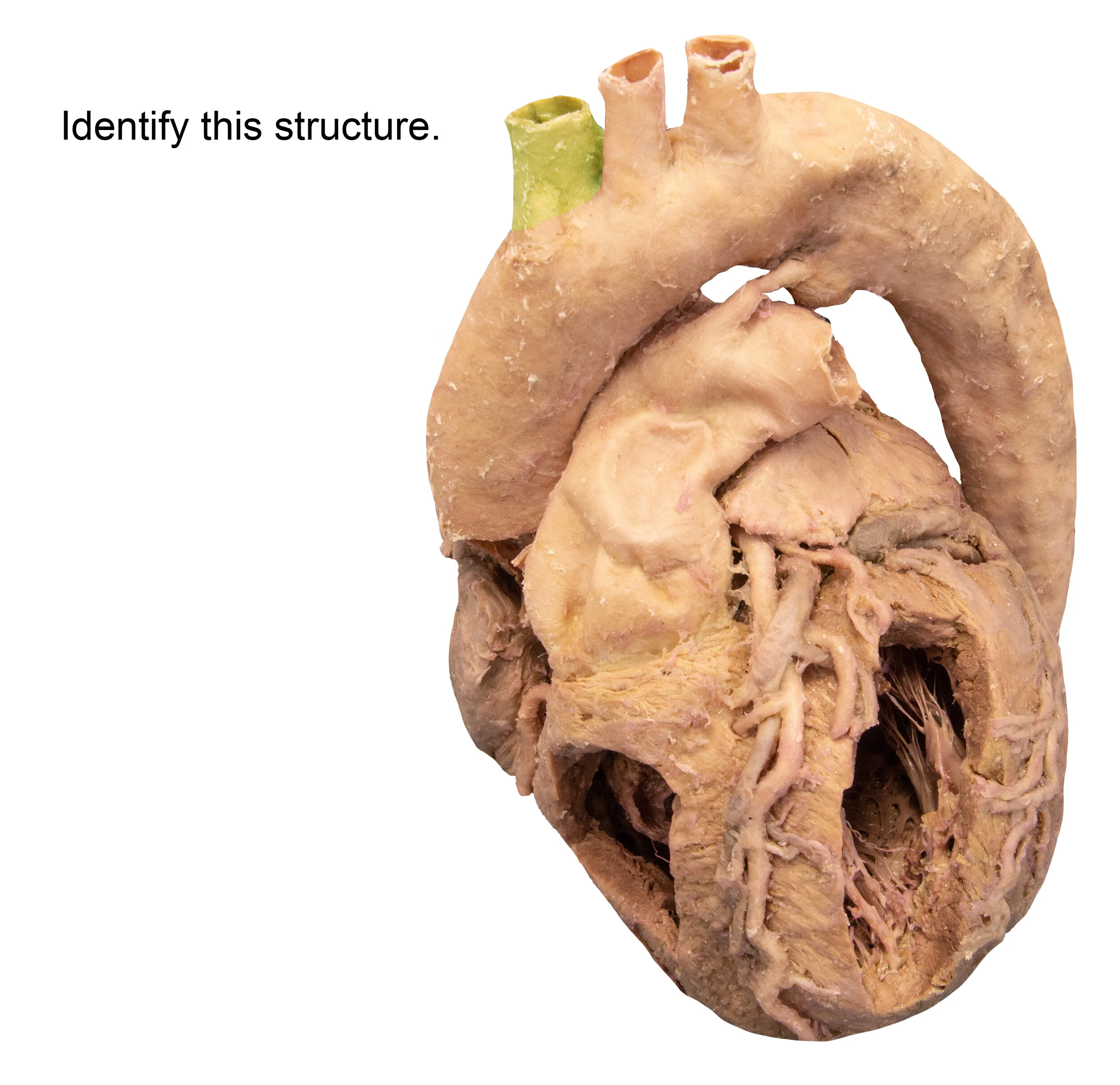 BrachiocephalicTrunk_editedimage_identify.jpg