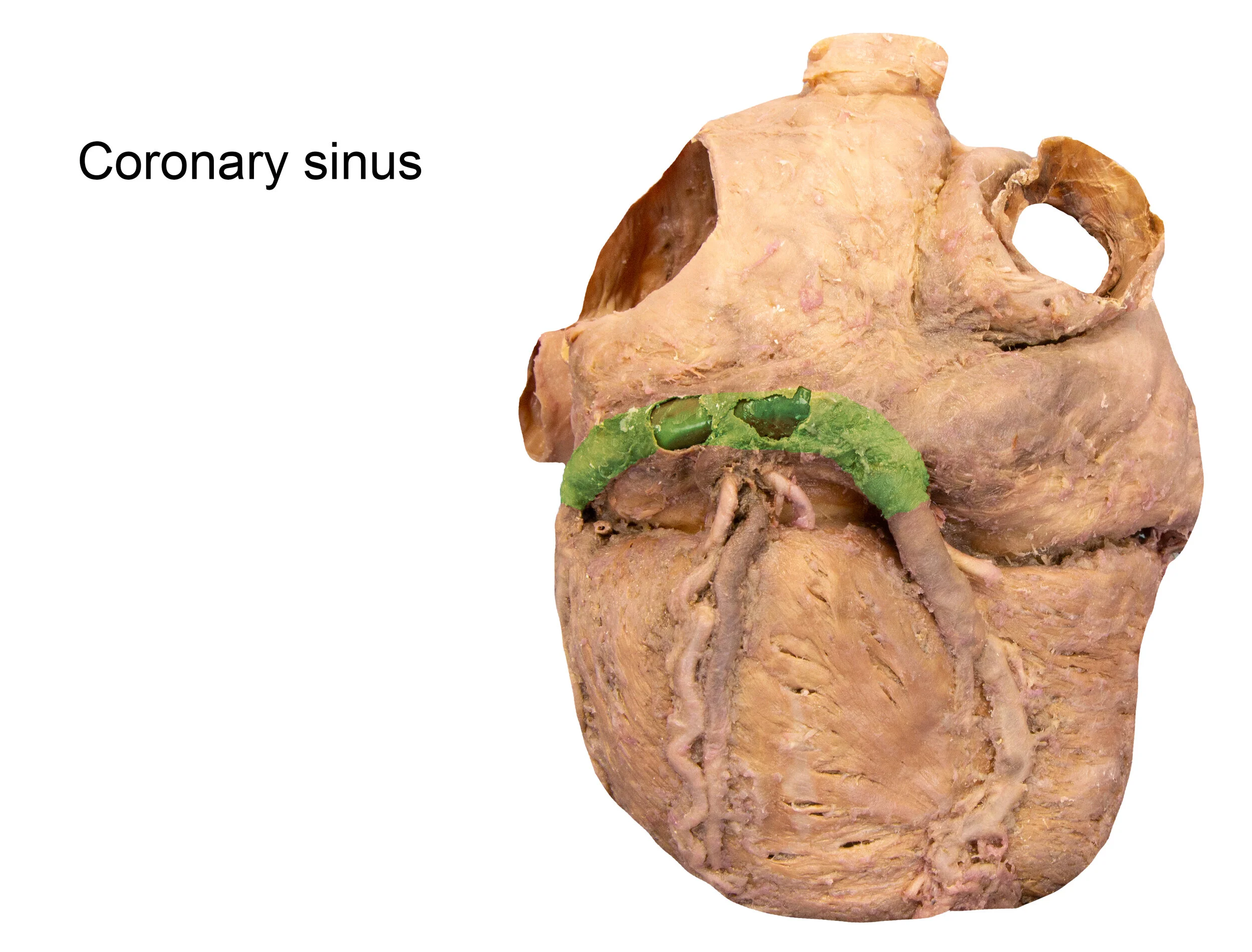 CoronarySinus_editedimage_labelled.jpg