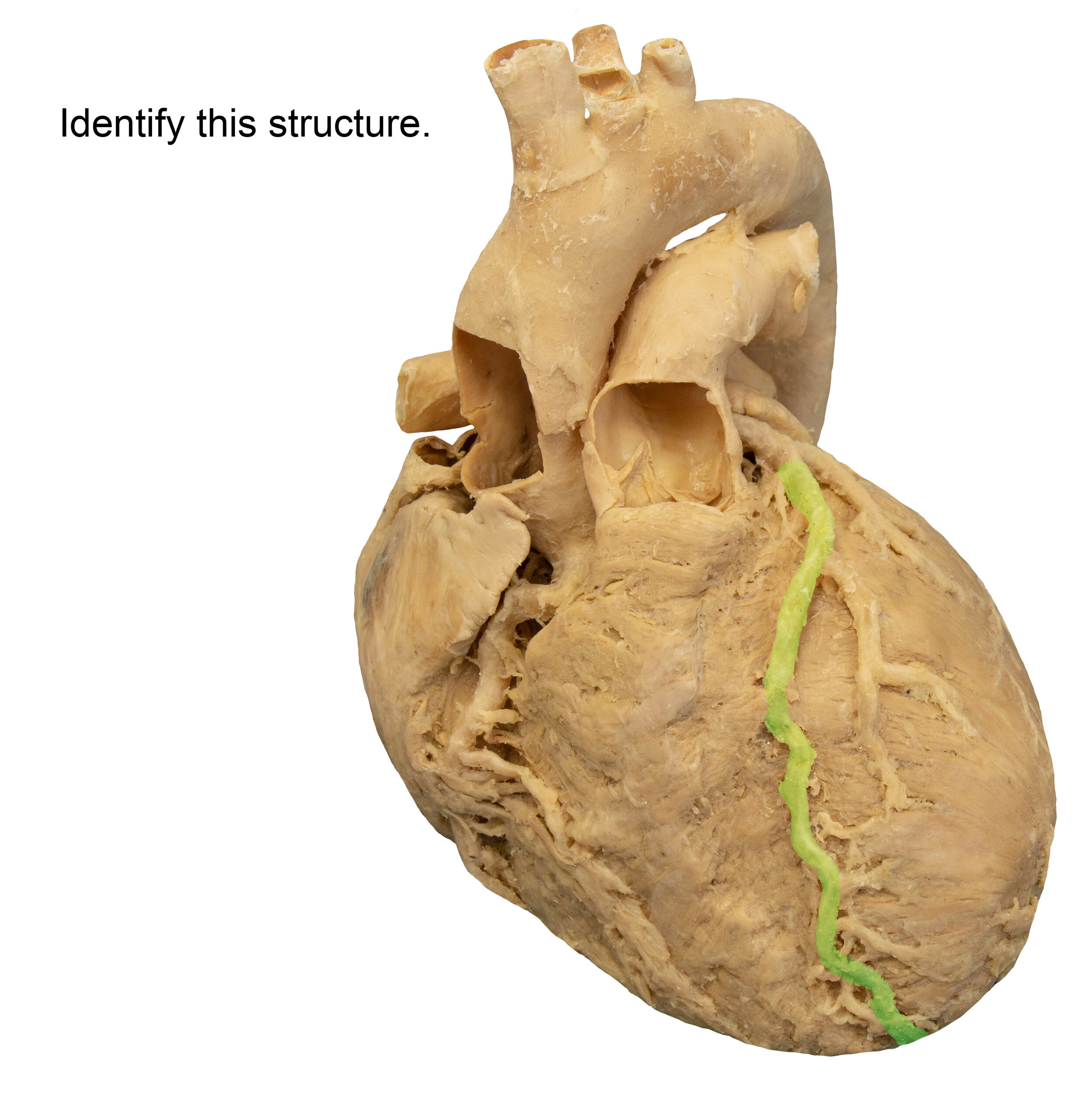 InterventricularArteryAnterior_editedimage_identify.jpg