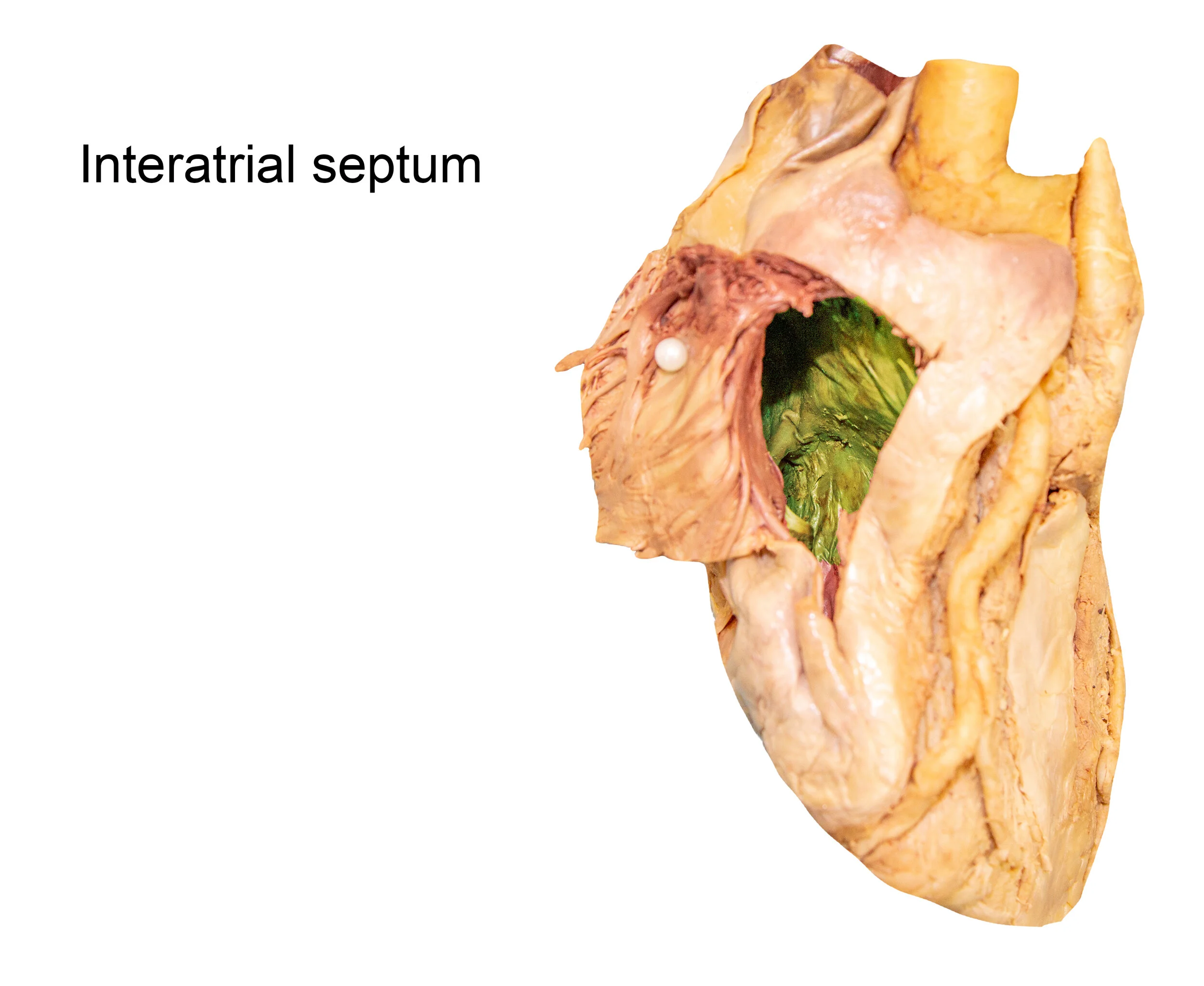 InteratrialSeptum_editedimage_labelled.jpg