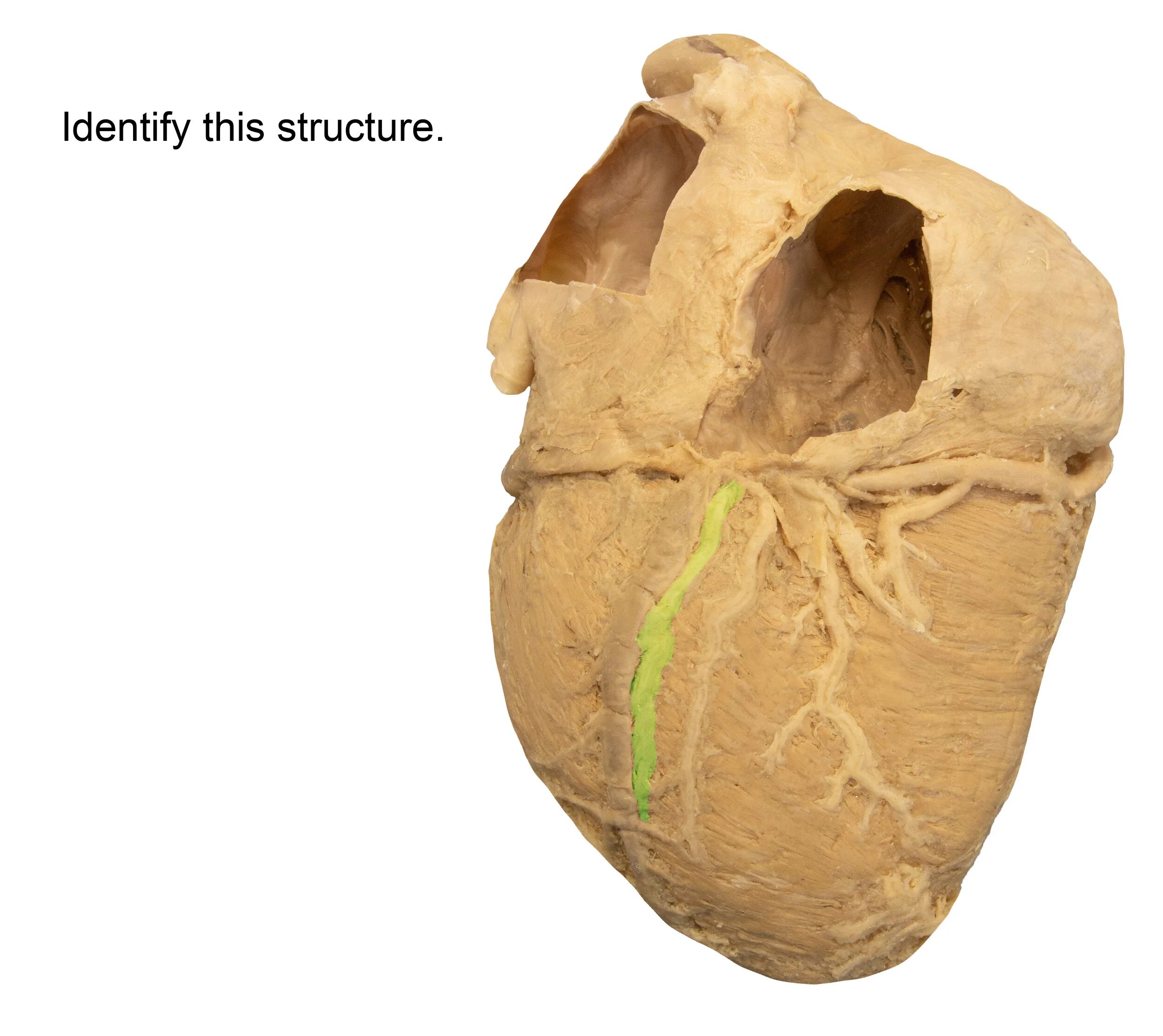 PosteriorDescendingArtery_editedimage_identify.jpg