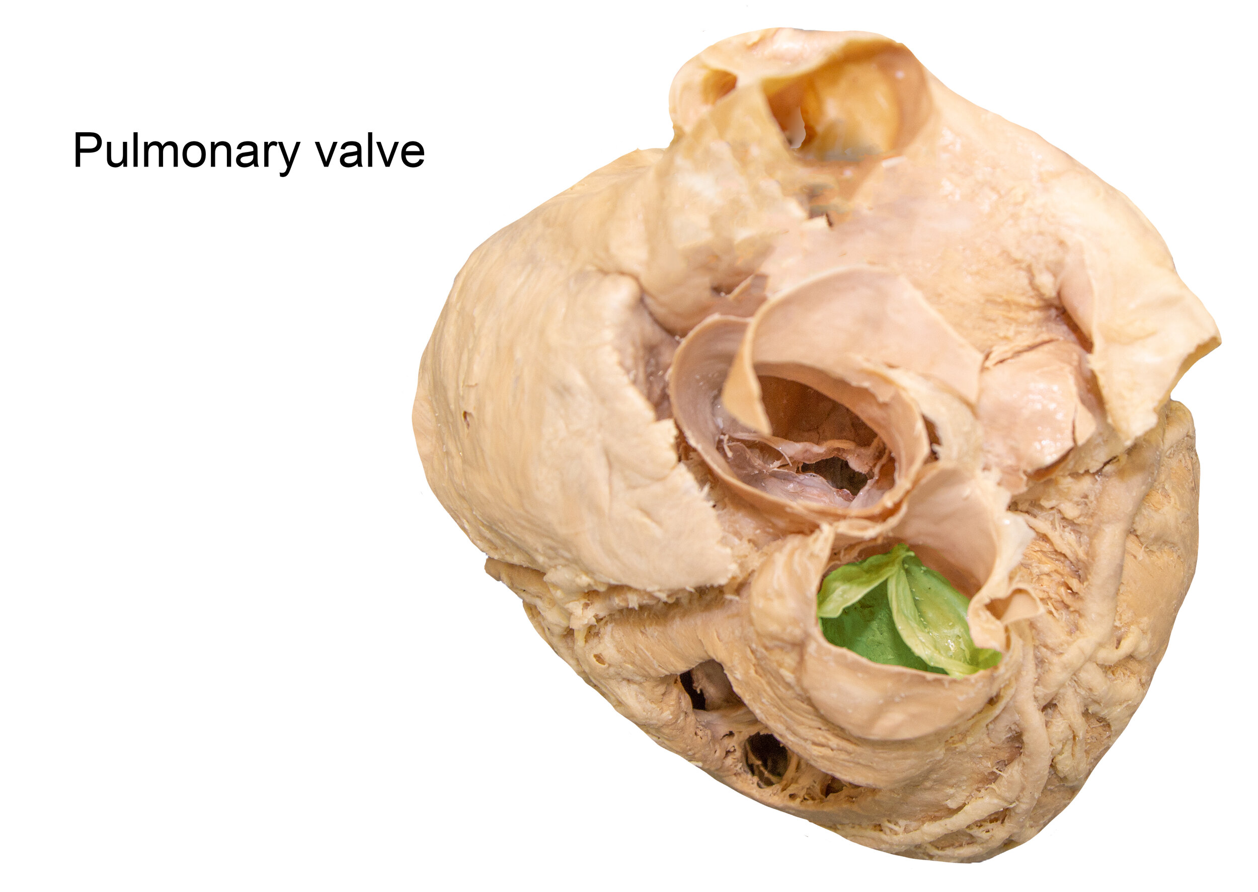 PulmonaryValve_editedimage_labelled.jpg