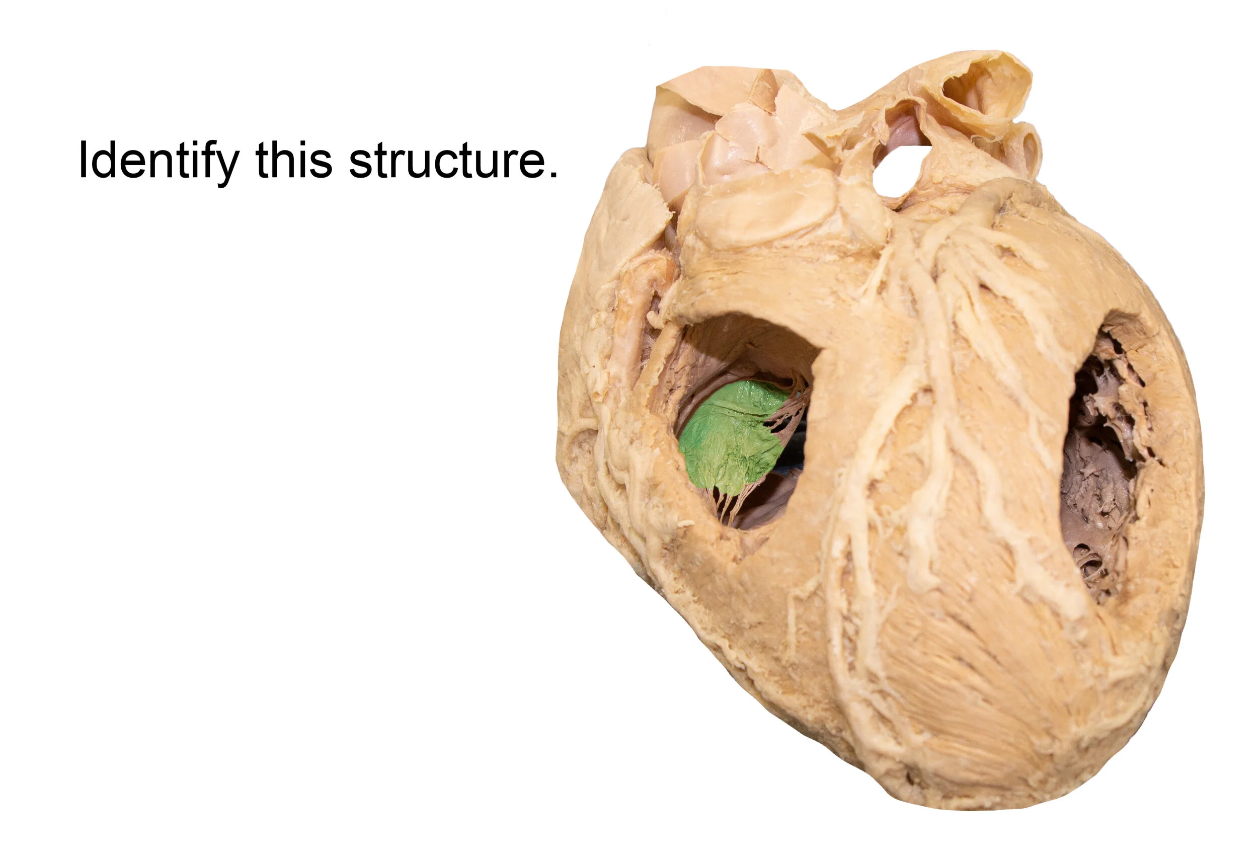 TricuspidValve_editedimage_identify.jpg