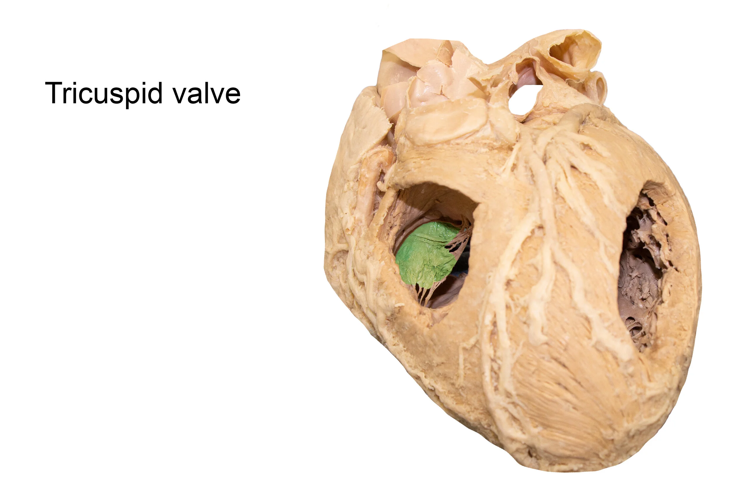 TricuspidValve_editedimage_labelled.jpg