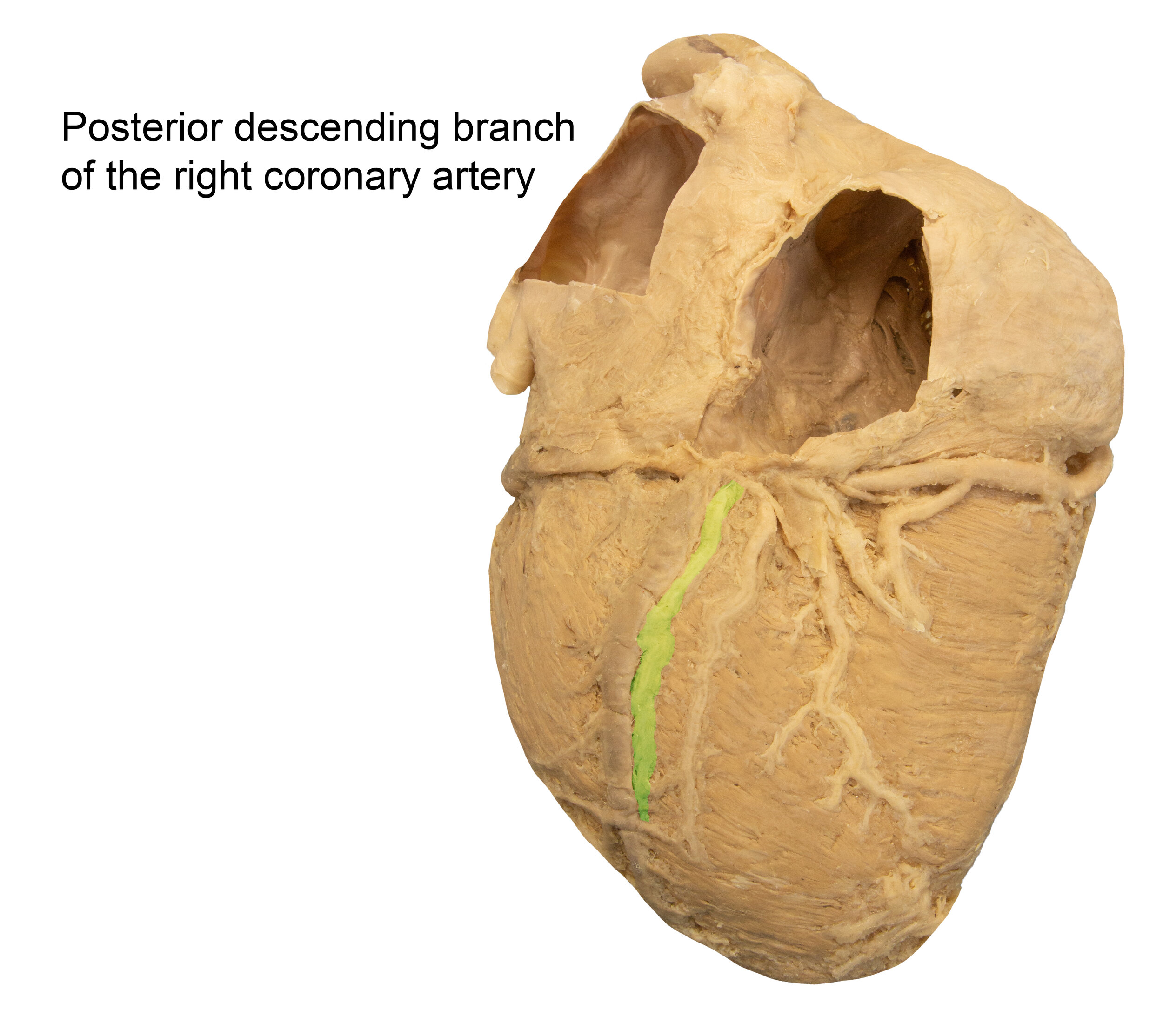 PosteriorDescendingArtery_editedimage_labelled.jpg