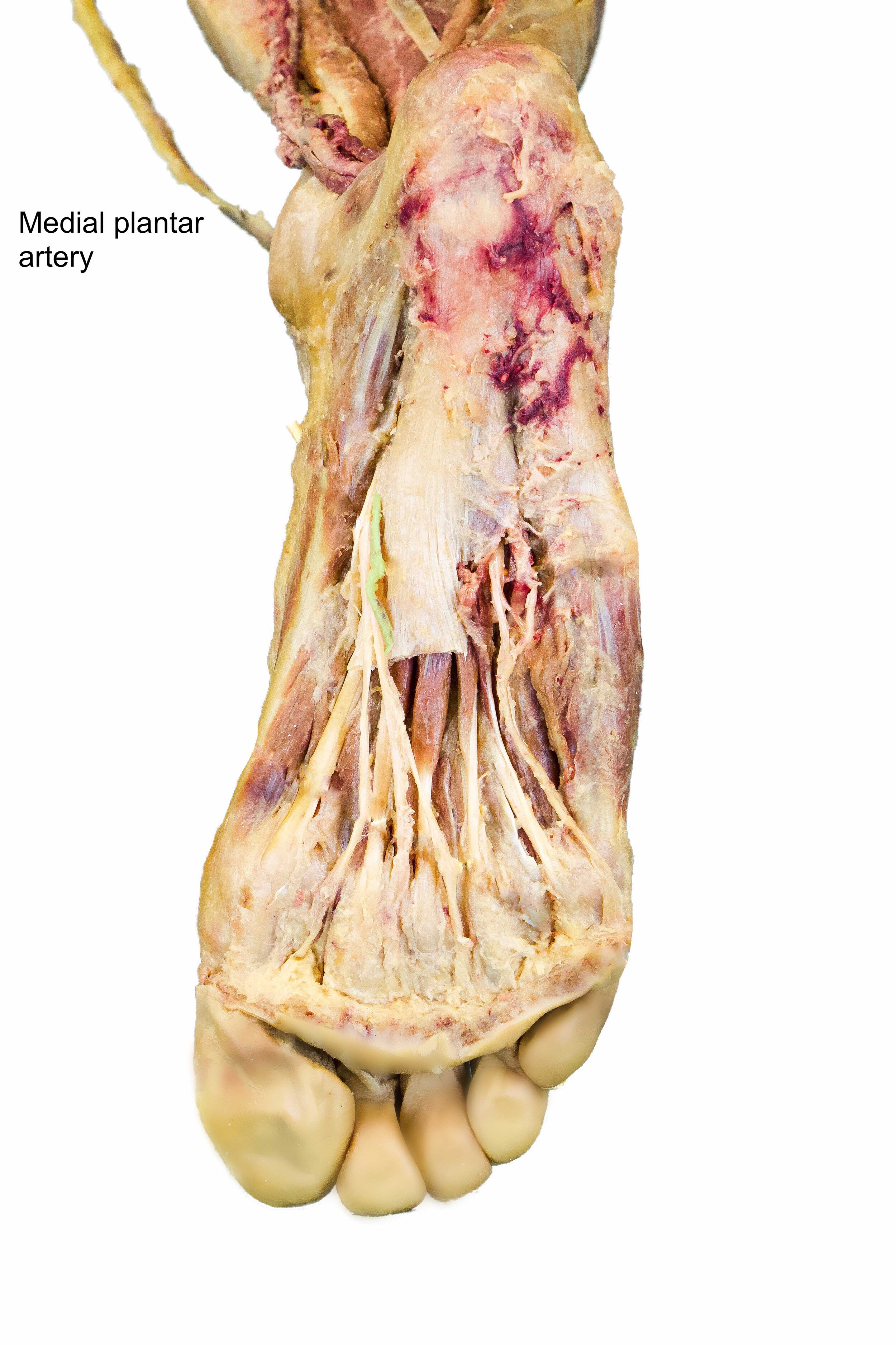 Medial_plantar_artery_edited_labelled.jpg