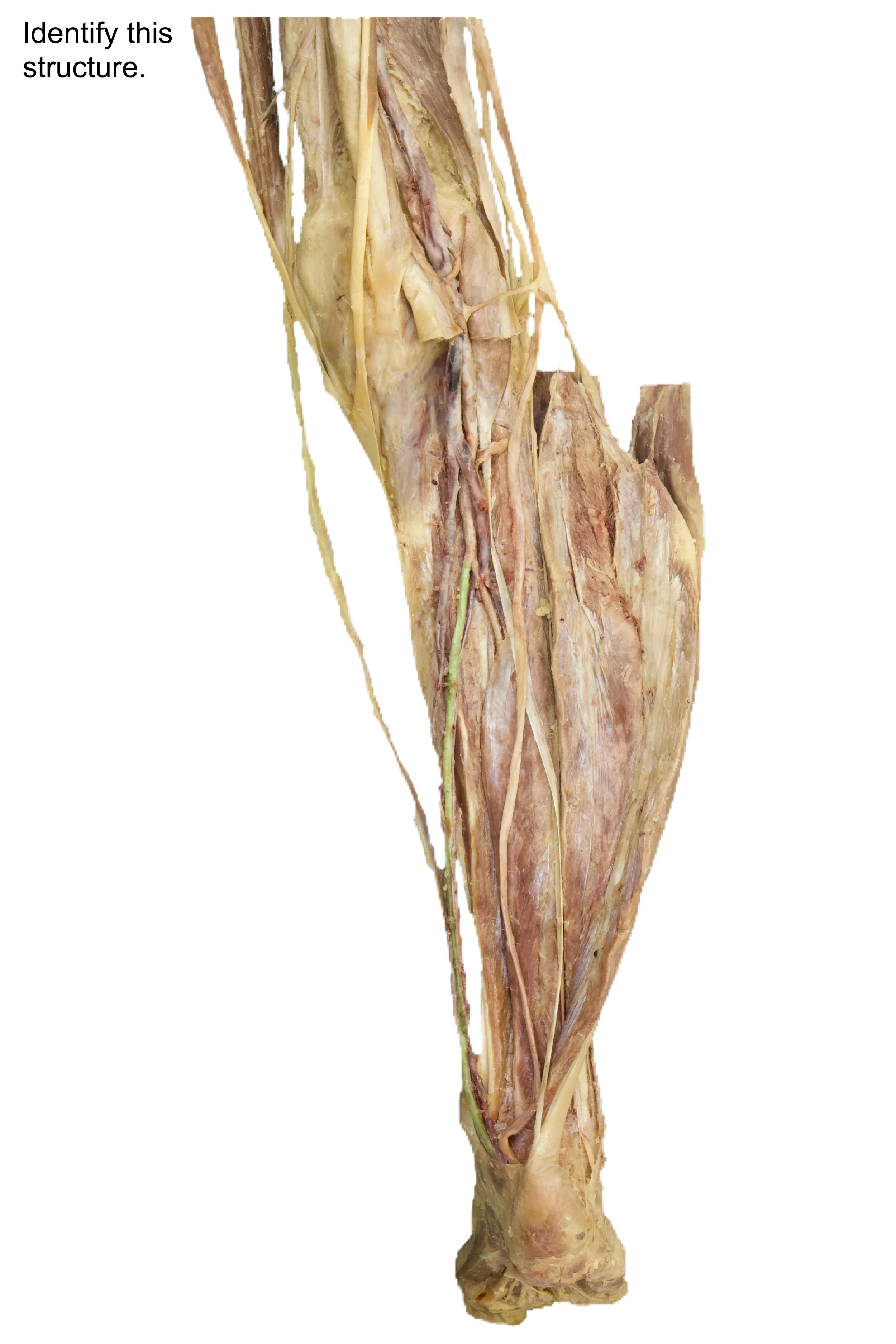 Posterior_tibial_artery_edited_identify.jpg