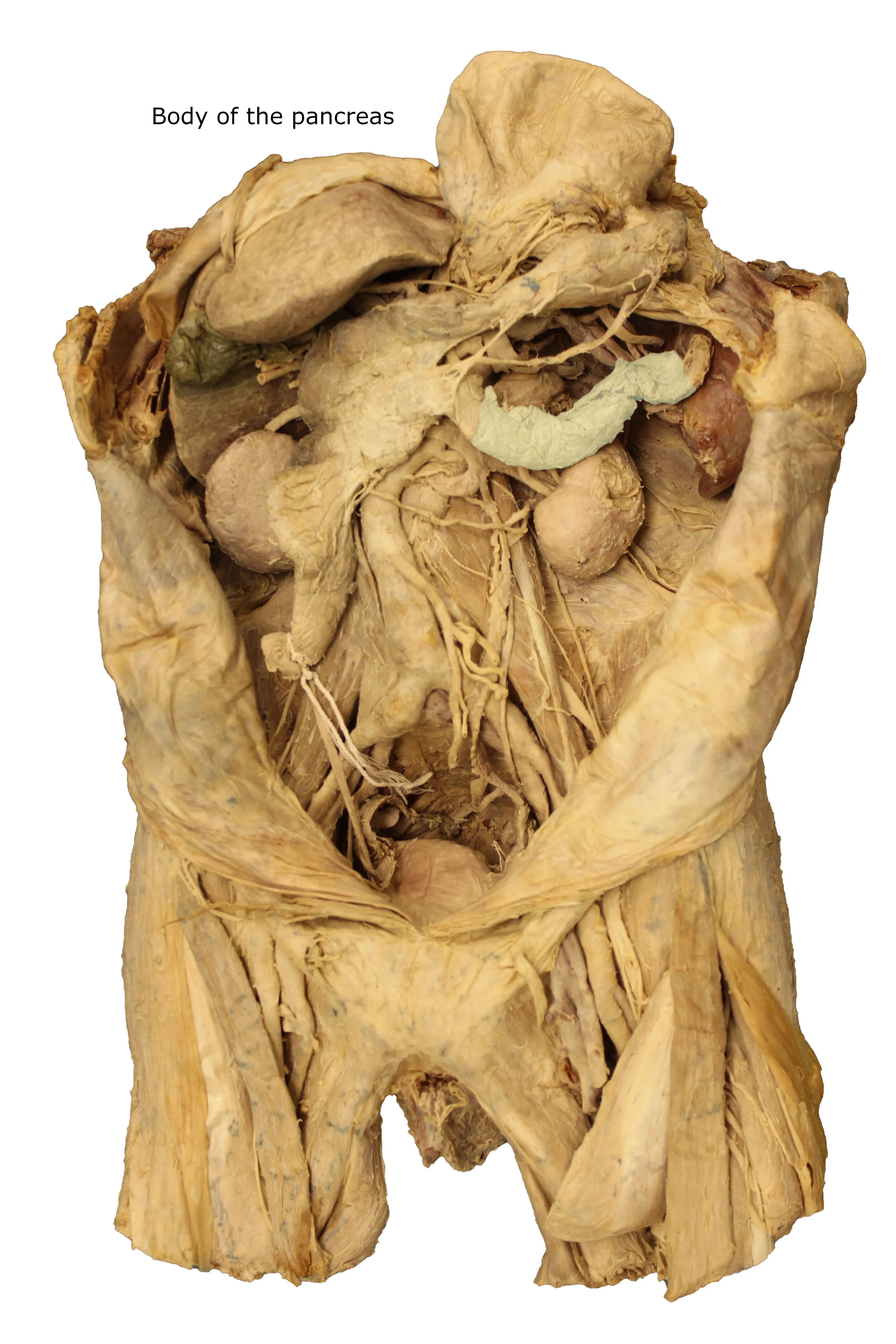 Body of the pancreas_editedimage_labelled.JPG