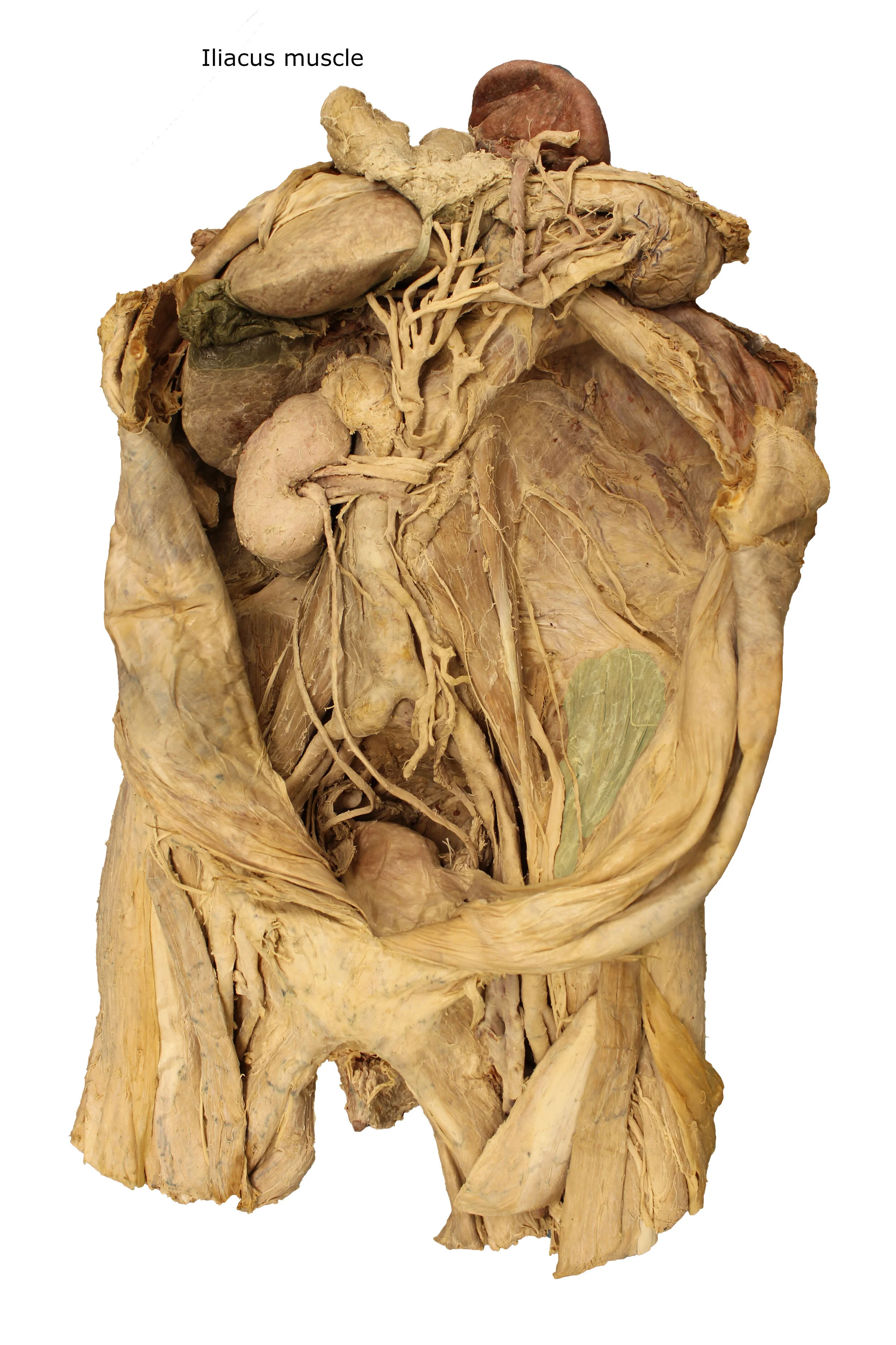 Iliacus muscle_editedimage_labelled.JPG