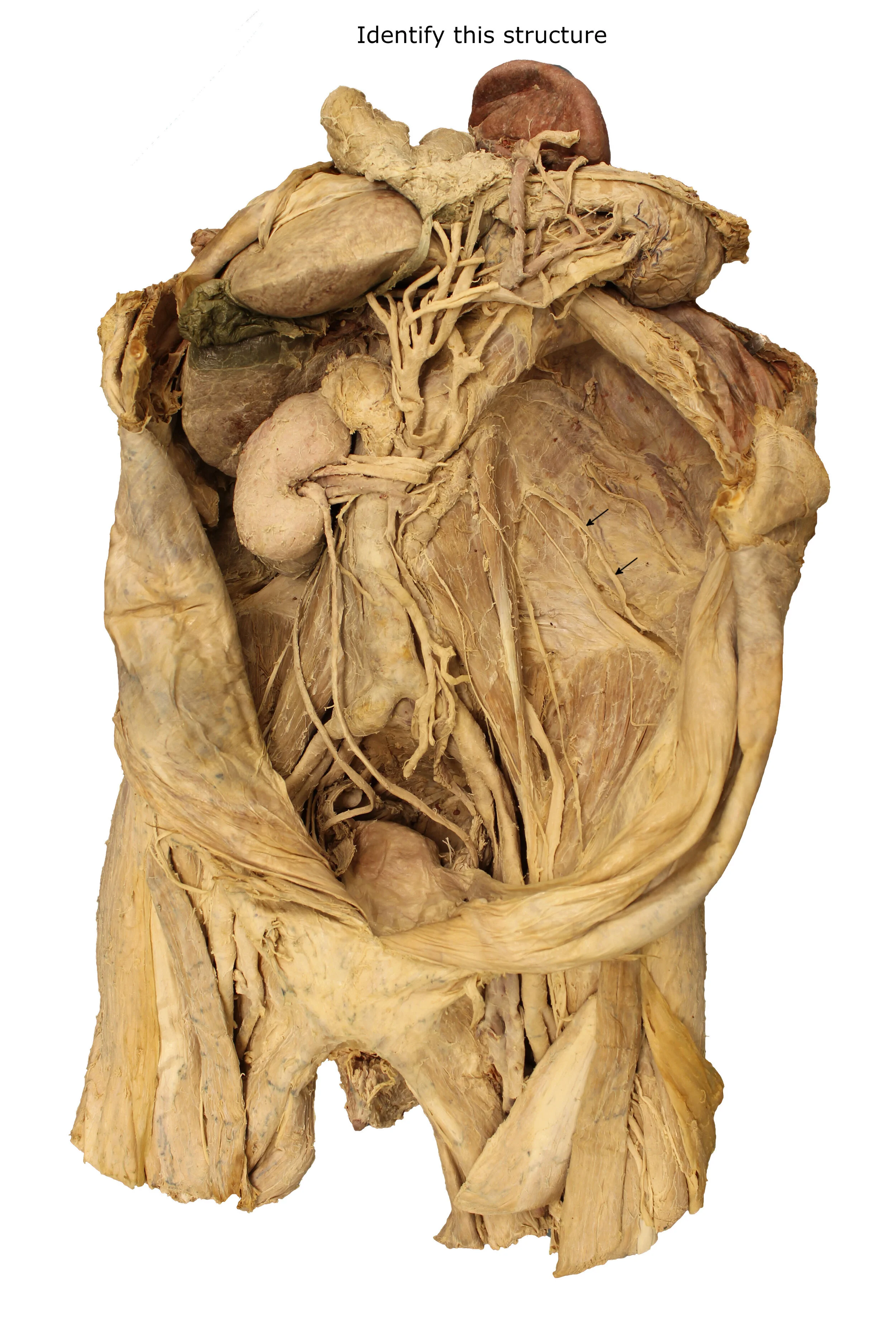 Iliohypogastric nerve_editedimage_identify.JPG