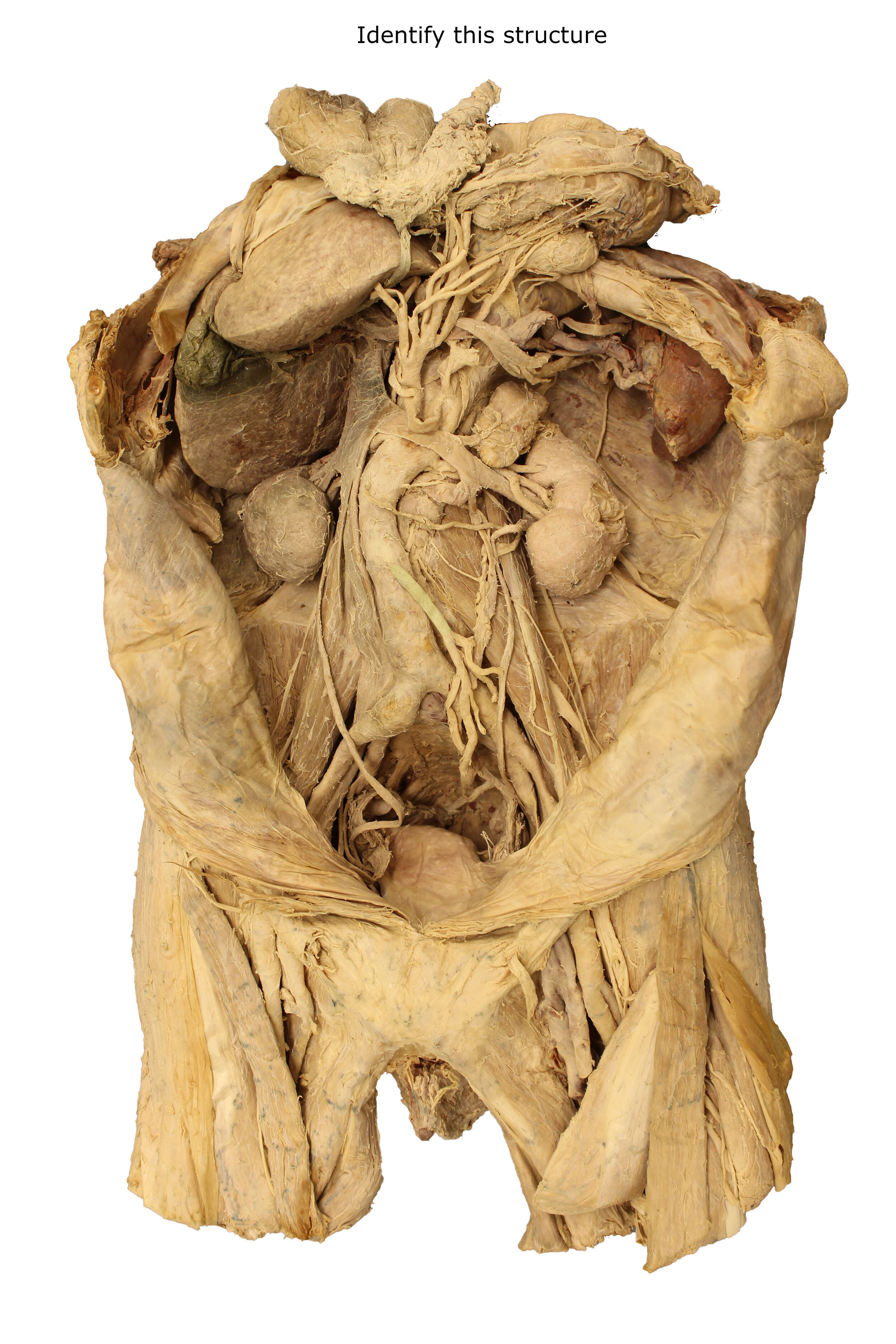 Inferior mesenteric artery_editedimage_identify.JPG