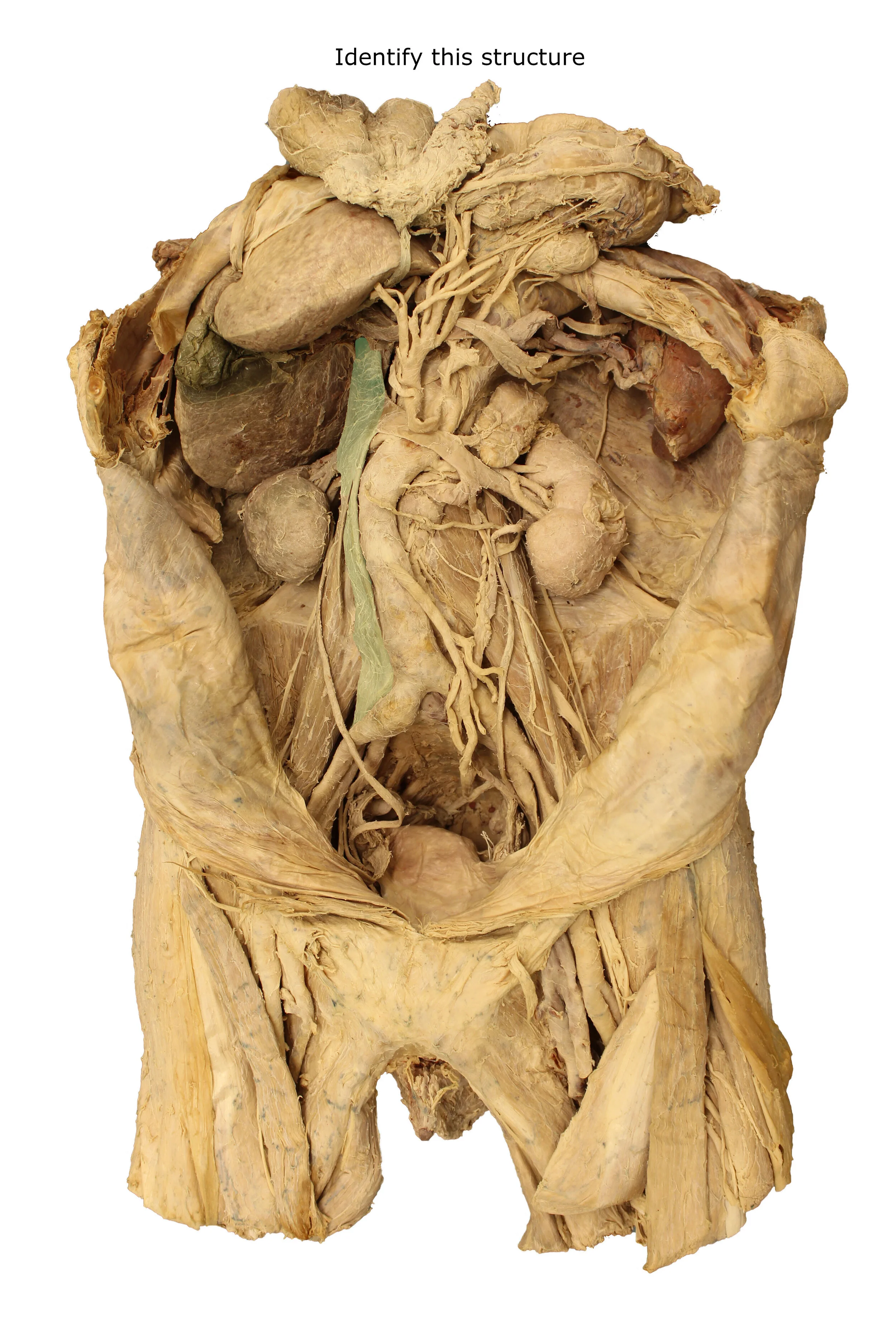 Inferior vena cava_editedimage_identify.JPG