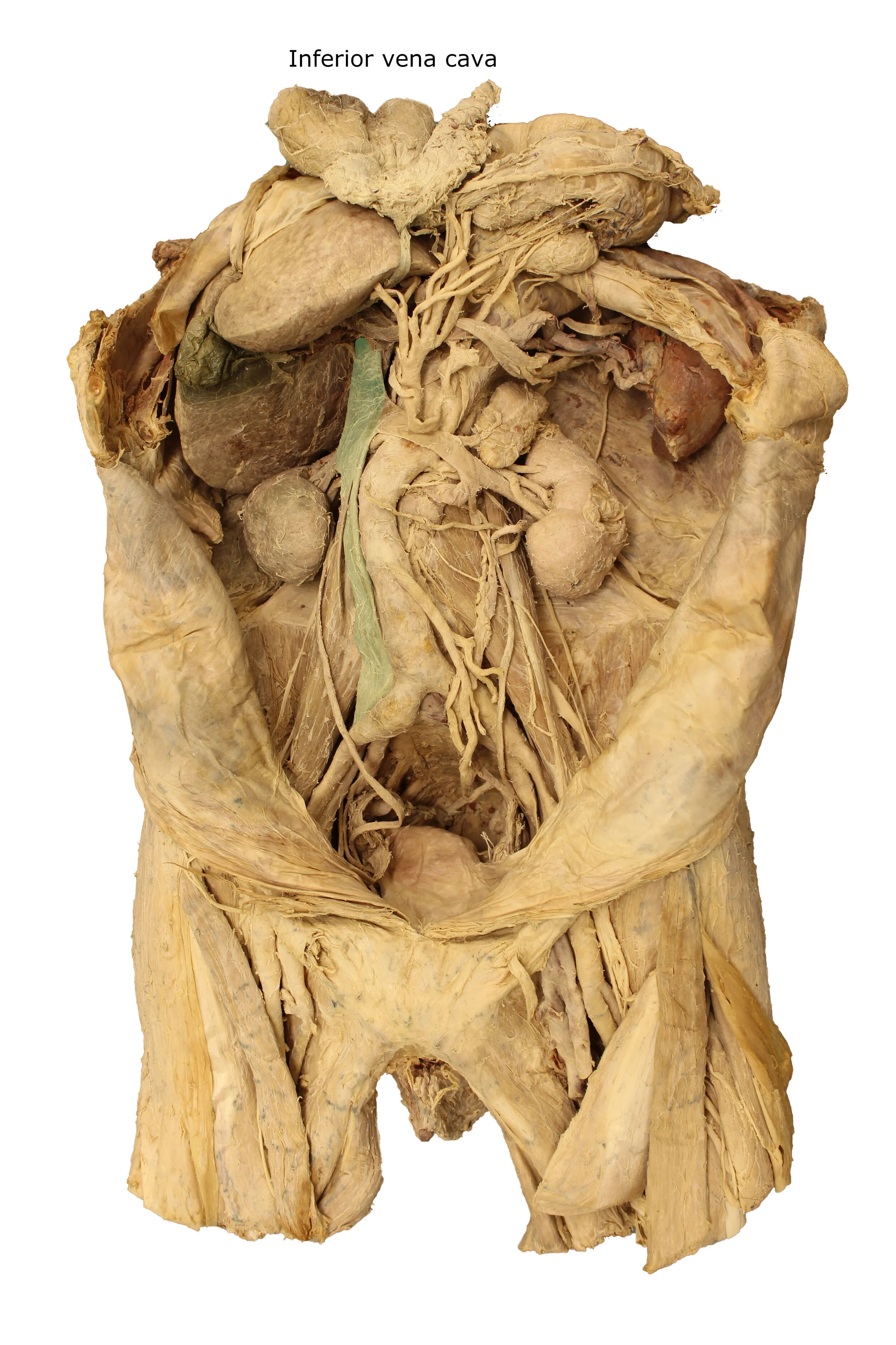 Inferior vena cava_editedimage_labelled.JPG