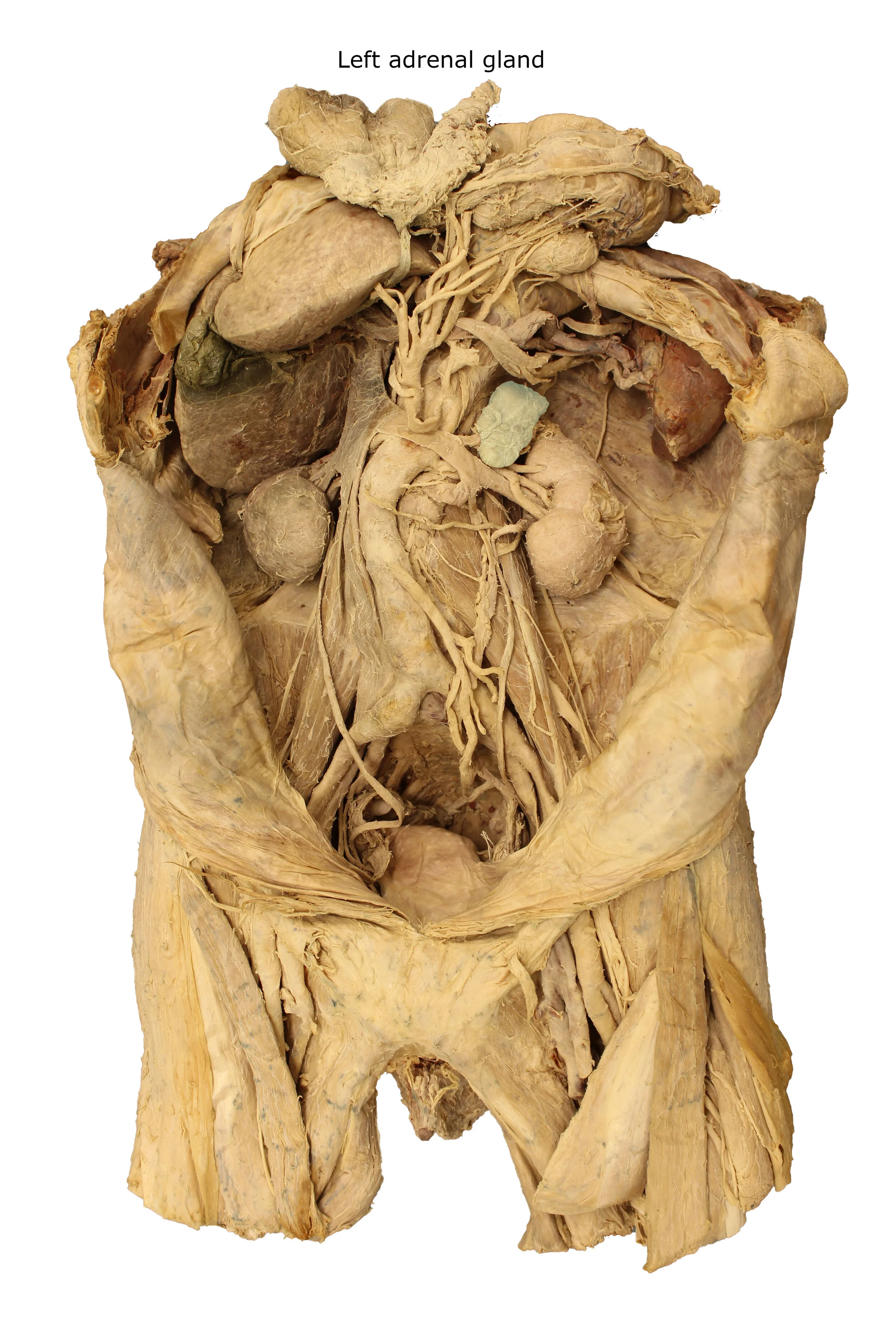 Left adrenal gland_editedimage_labelled.JPG