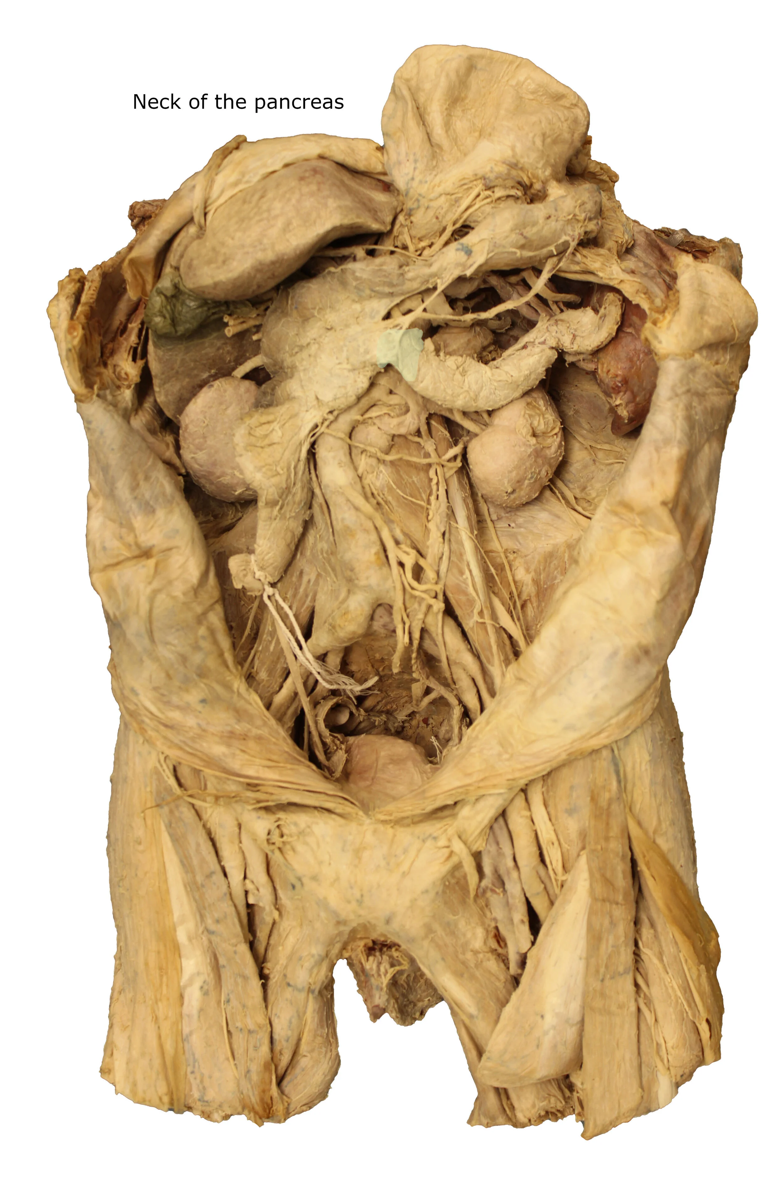 Neck of the pancreas_editedimage_labelled.JPG