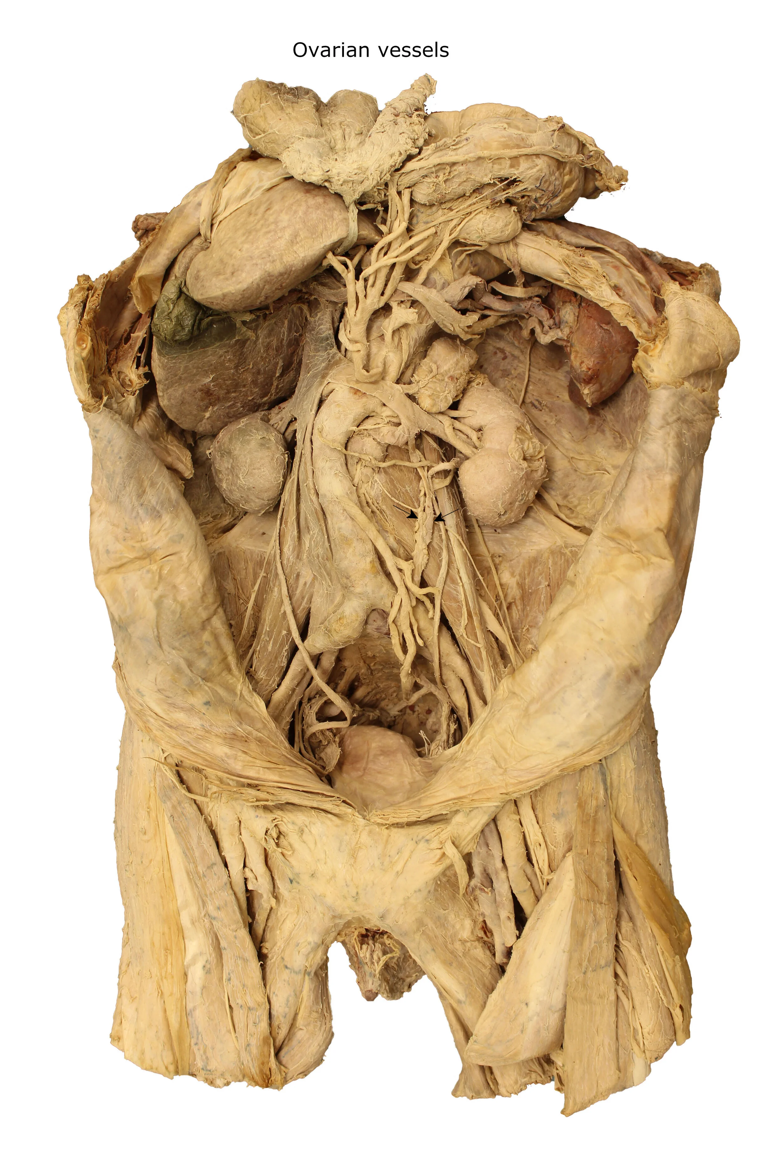 Ovarian vessels_editedimage_labelled.JPG