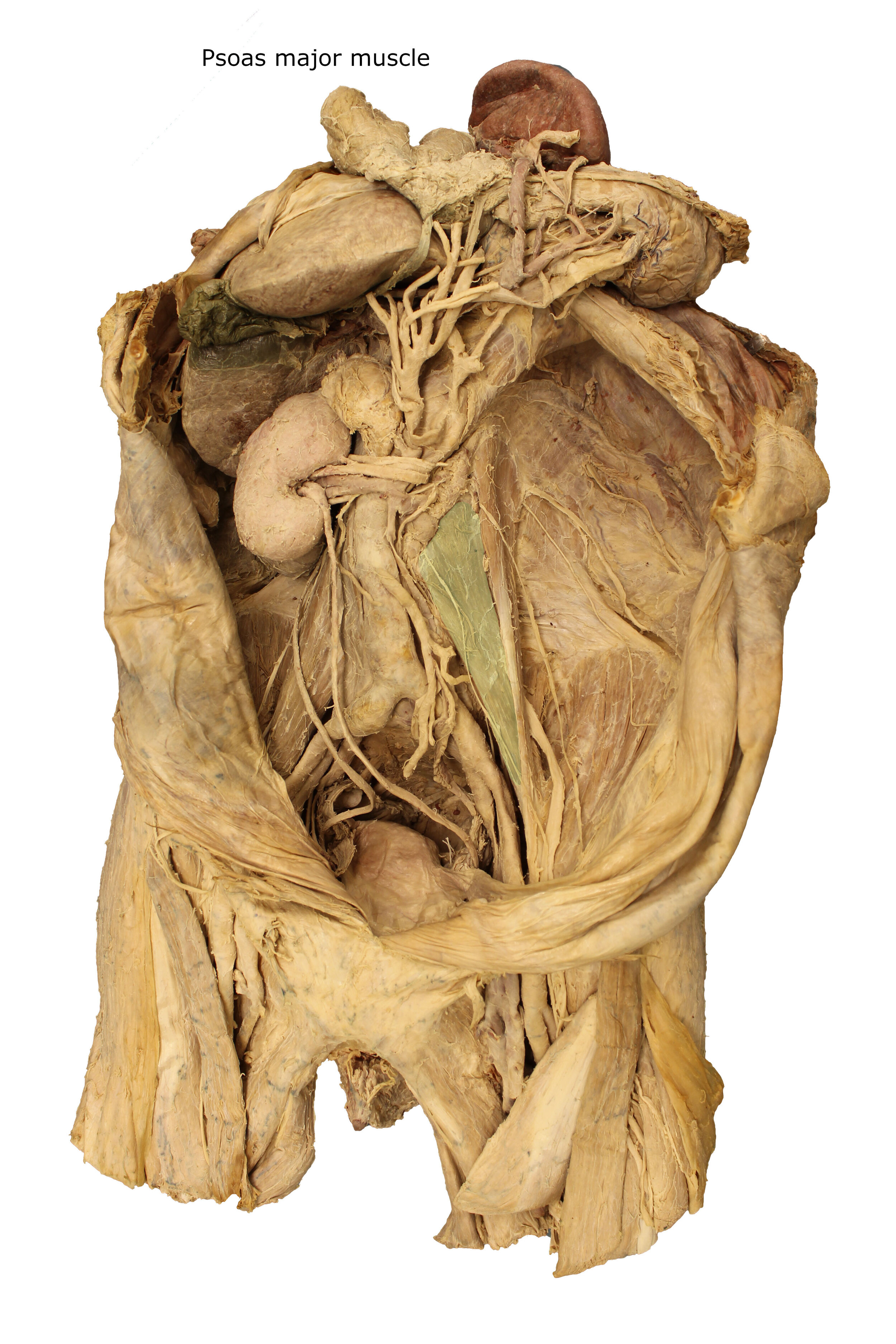 Psoas major muscle_editedimage_labelled.JPG