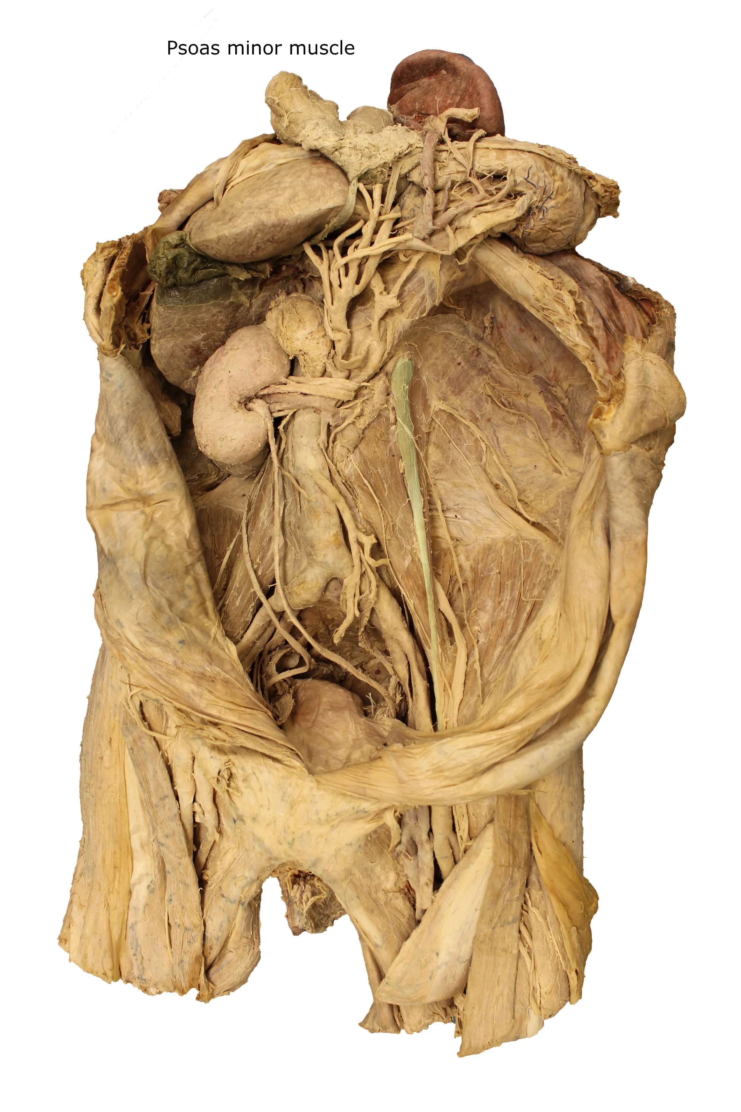 Psoas minor muscle_editedimage_labelled.JPG