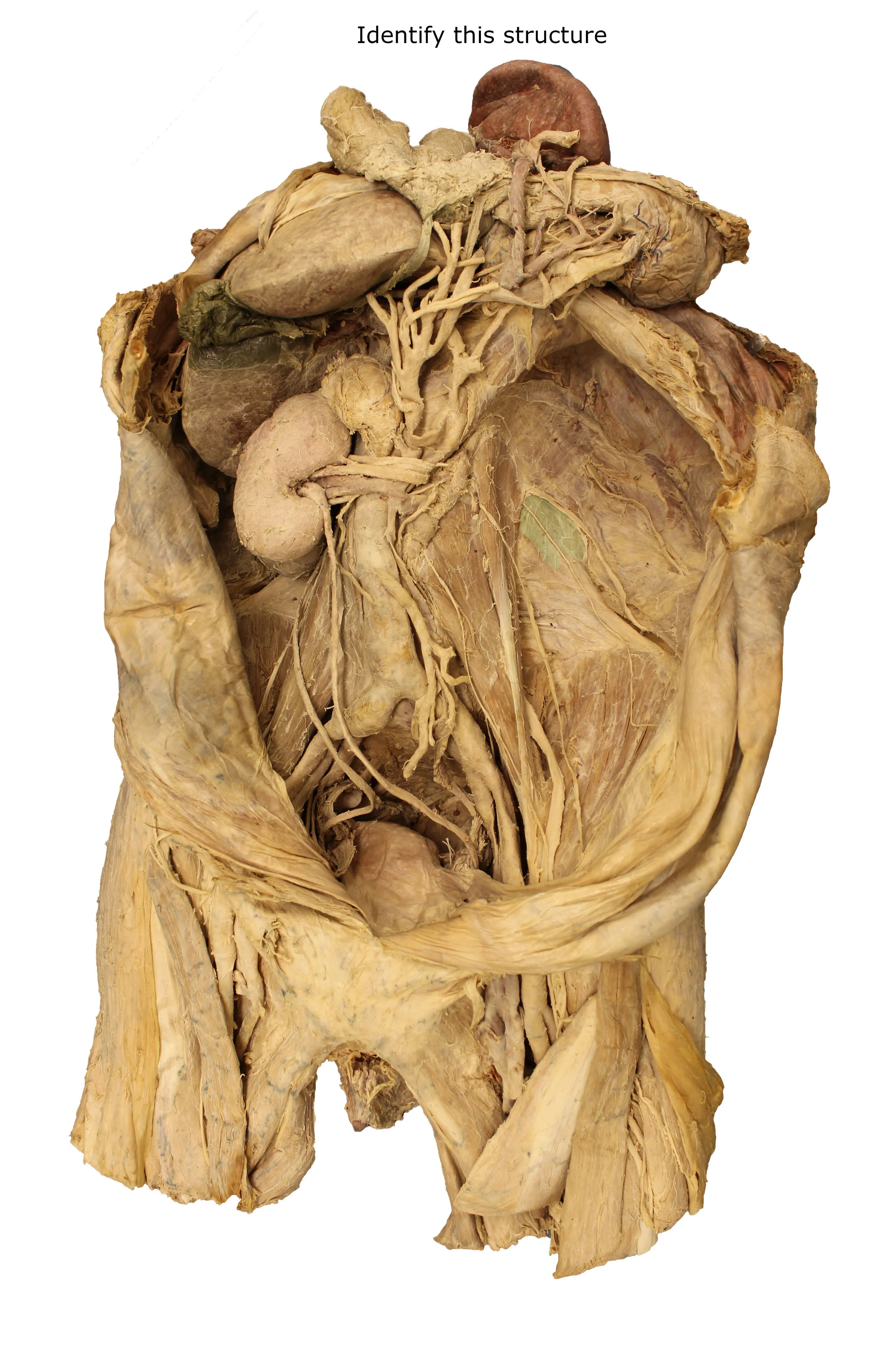 Quadratus lumborum muscle_editedimage_identify.JPG